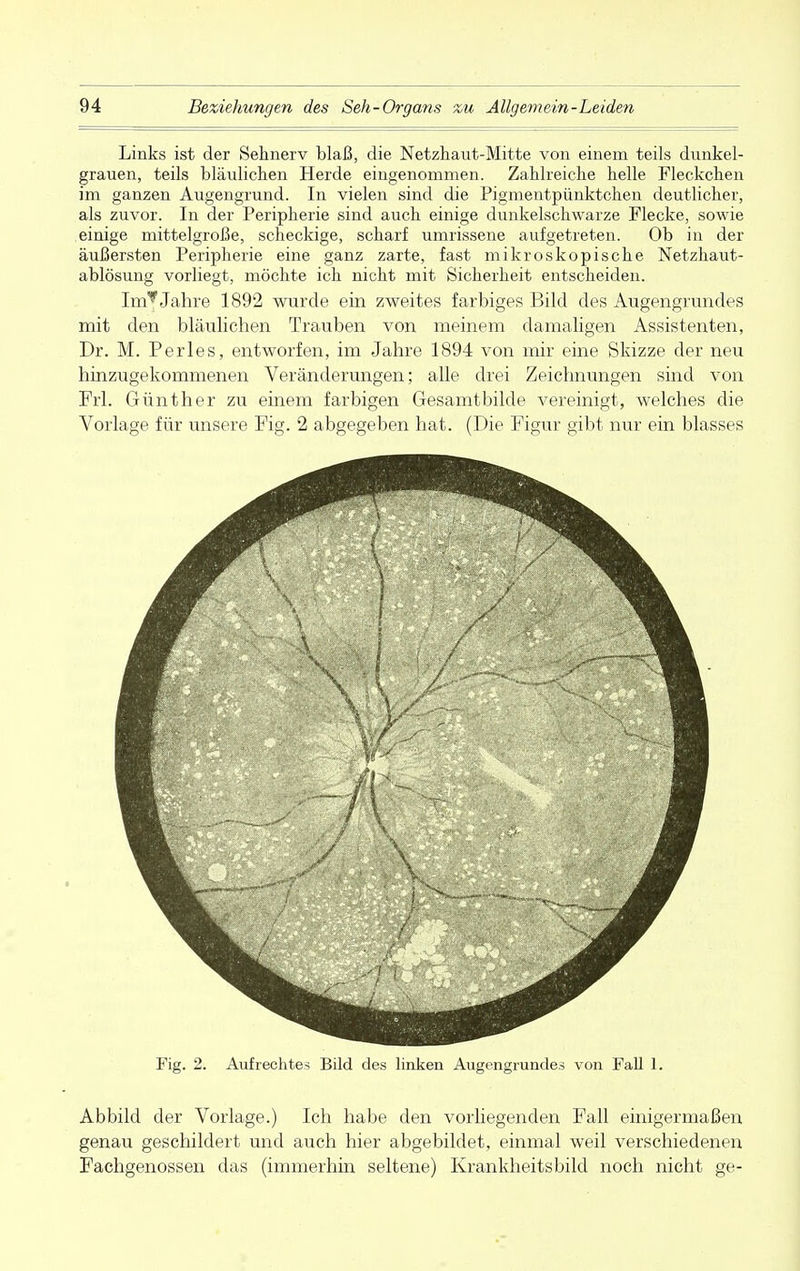 Links ist der Sehnerv blaß, die Netzhaut-Mitte von einem teils dunkel- grauen, teils bläulichen Herde eingenommen. Zahlreiche helle Fleckchen im ganzen Augengrund. In vielen sind die Pigmentpünktchen deutlicher, als zuvor. In der Peripherie sind auch einige dunkelschwarze Flecke, sowie einige mittelgroße, scheckige, scharf umrissene aufgetreten. Ob in der äußersten Peripherie eine ganz zarte, fast mikroskopische Netzhaut- ablösung vorliegt, möchte ich nicht mit Sicherheit entscheiden. ImJ Jahre 1892 wurde ein zweites farbiges Bild des Augengrundes mit den bläulichen Trauben von meinem damaligen Assistenten, Dr. M. Perles, entworfen, im Jahre 1894 von mir eine Skizze der neu hinzugekommenen Veränderungen; alle drei Zeichnungen sind von Frl. Günther zu einem farbigen Gesamtbilde vereinigt, welches die Vorlage für unsere Fig. 2 abgegeben hat. (Die Figur gibt nur ein blasses Fig. 2. Aufrechtes Bild des linken Augengrundes von Fall 1. Abbild der Vorlage.) Ich habe den vorliegenden Fall einigermaßen genau geschildert und auch hier abgebildet, einmal weil verschiedenen Fachgenossen das (immerhin seltene) Krankheitsbild noch nicht ge-