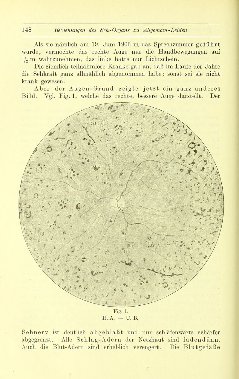 Als sie nämlich am 19. Juni 1906 in das Sprechzimmer geführt wurde, vermochte das rechte Auge nur die Handbewegungen auf 1/2 m wahrzunehmen, das linke hatte nur Lichtschein. Die ziemlich teilnahmlose Kranke gab an, daß im Laufe der Jahre die Sehkraft ganz allmählich abgenommen habe; sonst sei sie nicht krank gewesen. Aber der Augen-Grund zeigte jetzt ein ganz anderes Bild. Vgl. Fig. 1, welche das rechte, bessere Auge darstellt. Der Fig. 1. R. A. — U. B. Sehnerv ist deutlich abgeblaßt und nur schläfenwärts schärfer abgegrenzt. Alle Schlag-Adern der Netzhaut sind fadendünn. Auch die Blut-Adern sind erheblich verengert. Die Blutgefäße