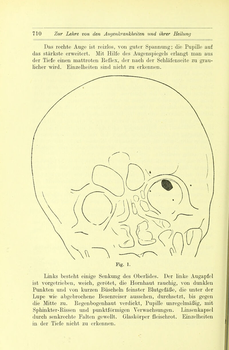 Das rechte Auge ist reizlos, von guter Spannung; die Pupille auf das stärkste erweitert. Mit Hilfe des Augenspiegels erlangt man aus der Tiefe einen mattroten Eeflex, der nach der Schläfenseite zu grau- licher wird. Einzelheiten sind nicht zu erkennen. Fig. 1. Links besteht einige Senkung des Oberlides. Der linke Augapfel ist vorgetrieben, weich, gerötet, die Hornhaut rauchig, von dunklen Punkten und von kurzen Büscheln feinster Blutgefäße, die unter der Lupe wie abgebrochene Besenreiser aussehen, durchsetzt, bis gegen die Mitte zu. Begenbogenhaut verdickt, Pupille unregelmäßig, mit Sphinkter-Bissen und punktförmigen Verwachsungen. Linsenkapsel durch senkrechte Falten gewellt. Glaskörper fleischrot. Einzelheiten in der Tiefe nicht zu erkennen.