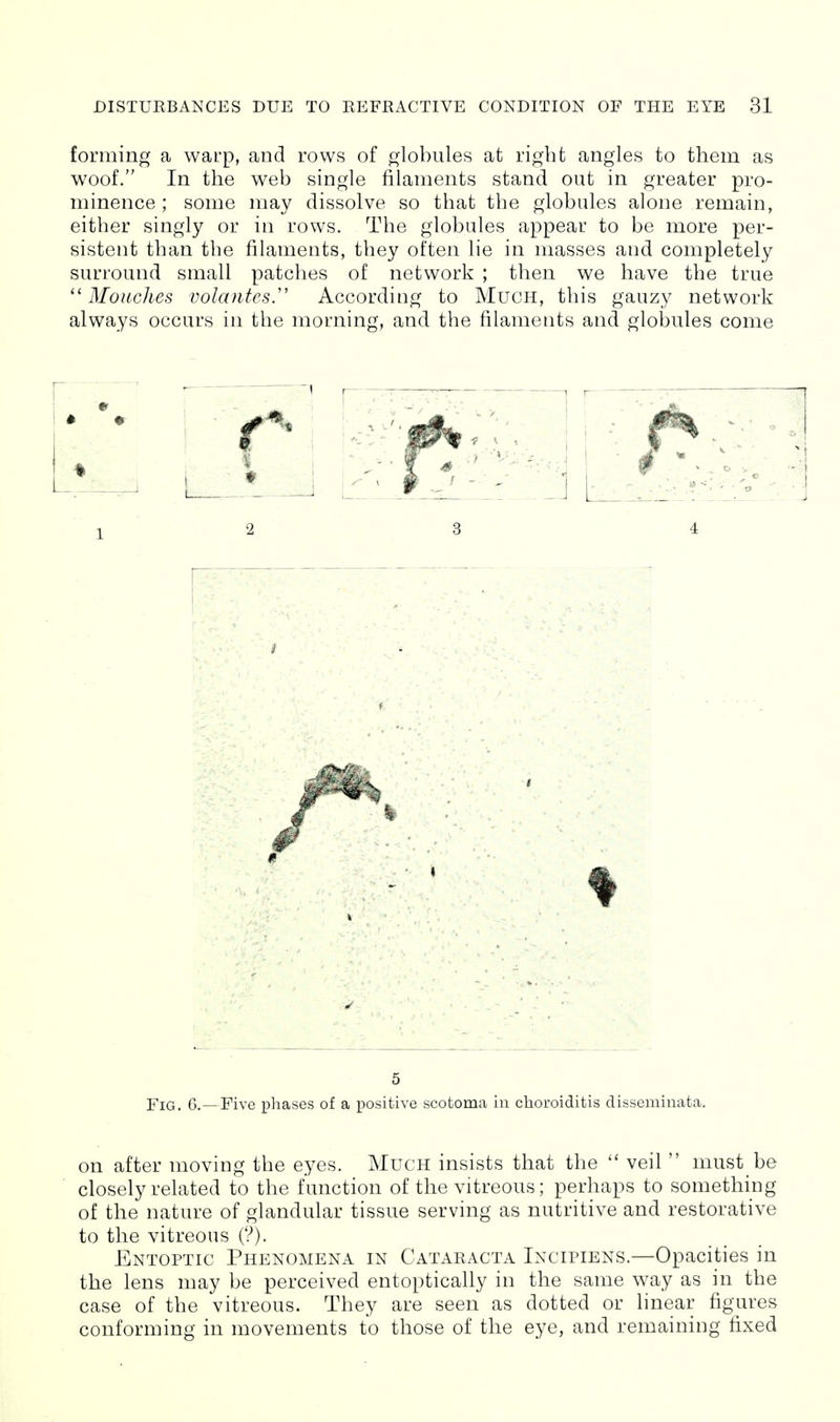 forming a warp, and rows of globules at right angles to them as woof. In the web single filaments stand out in greater pro- minence ; some may dissolve so that the globules alone remain, either singly or in rows. The globules appear to be more per- sistent than the filaments, they often lie in masses and completely surround small patches of network ; then we have the true  Mouches volantesy According to Much, this gauzy network always occurs in the morning, and the filaments and globules come 5 Fig. 6.—Five phases of a positive scotoma in choroiditis disseminata. on after moving the eyes. Much insists that the  veil  must be closely related to the function of the vitreous; perhaps to something of the nature of glandular tissue serving as nutritive and restorative to the vitreous (?). Entoptic Phenomena in Cataracta Incipiens.—Opacities in the lens may be perceived entoptically in the same way as in the case of the vitreous. They are seen as dotted or linear figures conforming in movements to those of the eye, and remaining fixed