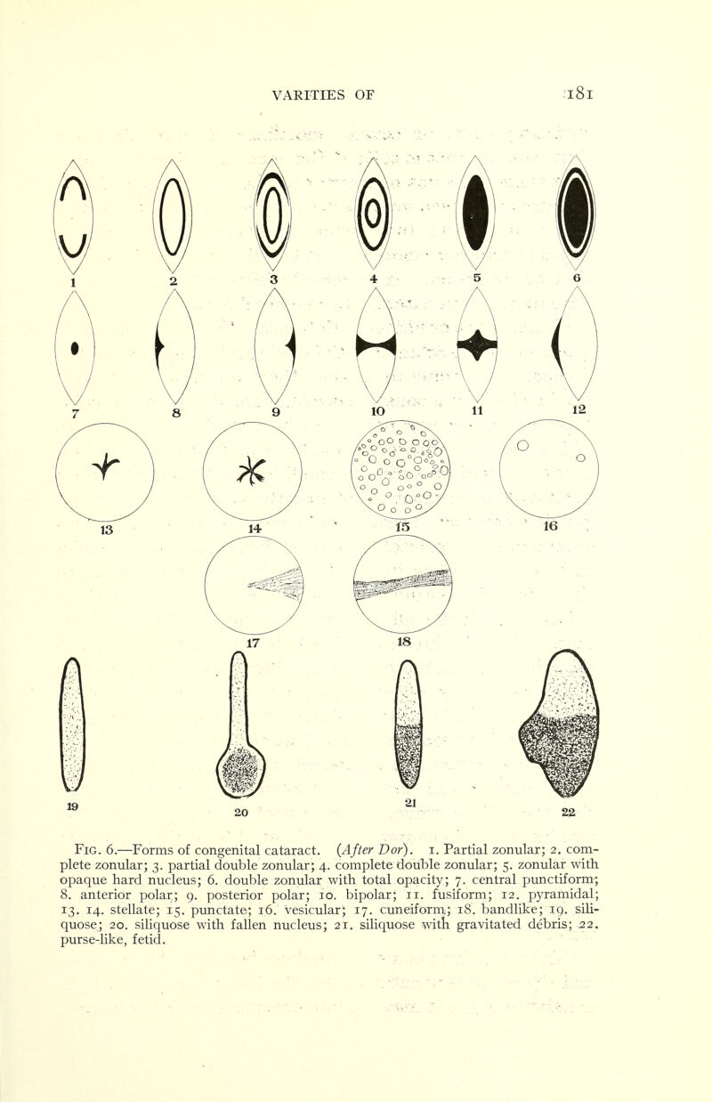 VARITIES OF Fig. 6.—Forms of congenital cataract. (After Dor), i. Partial zonular; 2. com- plete zonular; 3. partial double zonular; 4. complete double zonular; 5. zonular with opaque hard nucleus; 6. double zonular with total opacity; 7. central punctiform; 8. anterior polar; 9. posterior polar; 10. bipolar; 11. fusiform; 12, pyramidal; 13. 14. stellate; 15. punctate; 16. vesicular; 17, cuneiform; 18. bandlike; 19. siU- quose; 20. siliquose with fallen nucleus; 21. siliquose witli gravitated debris; 22. purse-like, fetid. ■ ' - ■