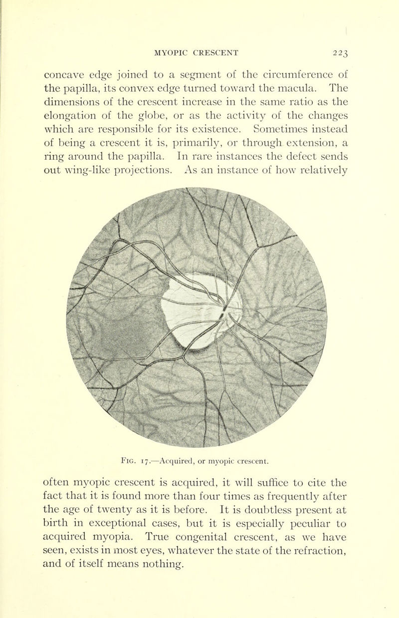 I MYOPIC CRESCENT 223 concave edge joined to a segment of the circumference of the papilla, its convex edge turned toward the macula. The dimensions of the crescent increase in the same ratio as the elongation of the globe, or as the activity of the changes which are responsible for its existence. Sometimes instead of being a crescent it is, primarily, or through extension, a ring around the papilla. In rare instances the defect sends out wing-like projections. As an instance of how relatively Fig. 17.—Acquired, or myopic crescent. often myopic crescent is acquired, it will suffice to cite the fact that it is found more than four times as frequently after the age of twenty as it is before. It is doubtless present at birth in exceptional cases, but it is especially peculiar to acquired myopia. True congenital crescent, as we have seen, exists in most eyes, whatever the state of the refraction, and of itself means nothing.