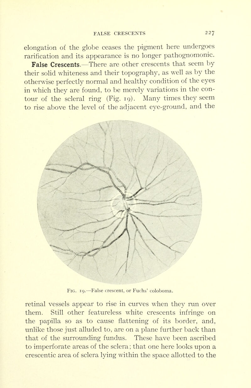 elongation of the globe ceases the pigment here undergoes rarification and its appearance is no longer pathognomonic. False Crescents.—There are other crescents that seem by their soHd whiteness and their topography, as well as by the otherwise perfectly normal and healthy condition of the eyes in which they are found, to be merely variations in the con- tour of the scleral ring (Fig. 19). Many times they seem to rise above the level of the adjacent eye-ground, and the A-' Fig. 19.—False crescent, or Fuchs' coloboma. retinal vessels appear to rise in curves when they run over them. Still other featureless white crescents infringe on the papilla so as to cause flattening of its border, and, unlike those just alluded to, are on a plane further back than that of the surrounding fundus. These have been ascribed to imperforate areas of the sclera; that one here looks upon a crescentic area of sclera lying within the space allotted to the