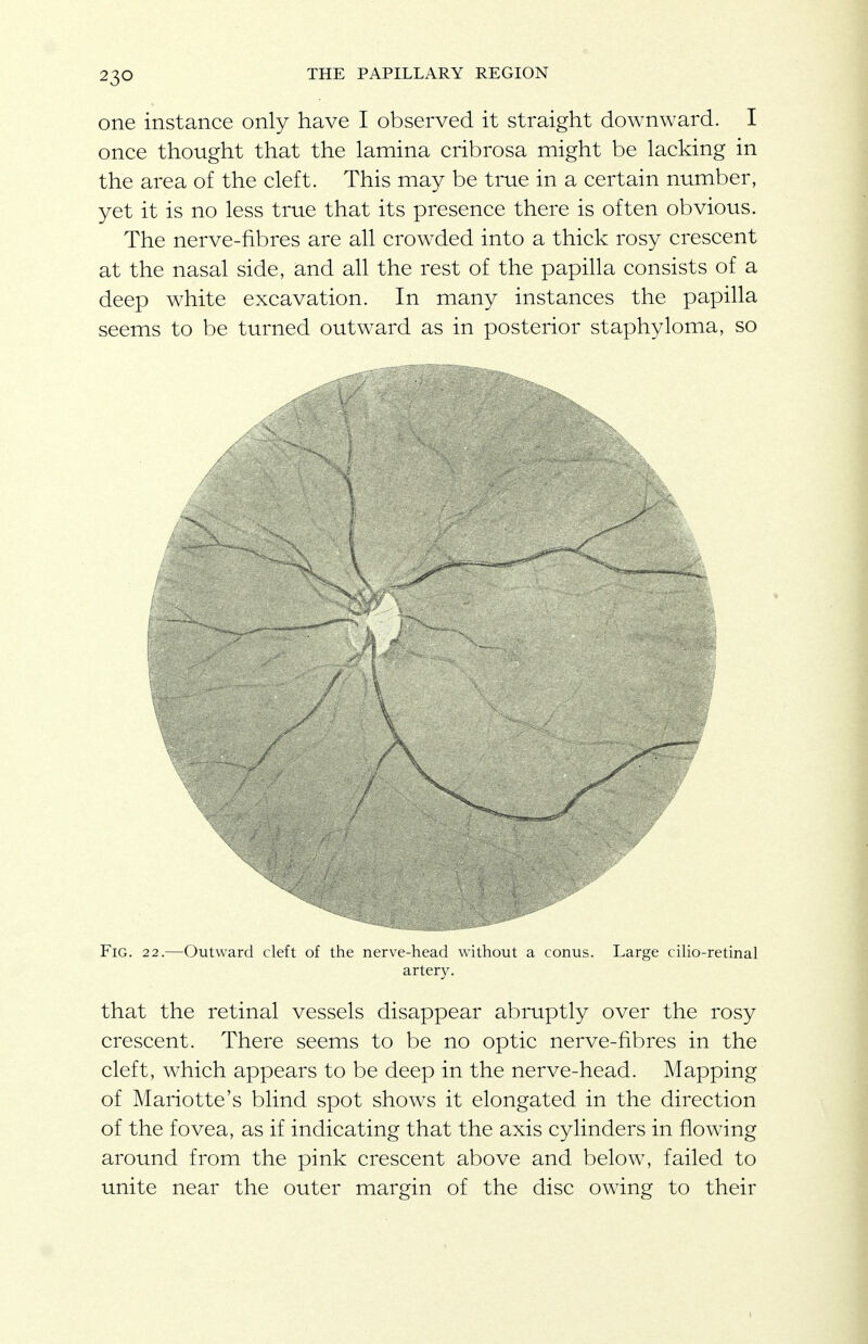 one instance only have I observed it straight downward. I once thought that the lamina cribrosa might be lacking in the area of the cleft. This may be true in a certain number, yet it is no less true that its presence there is often obvious. The nerve-fibres are all crowded into a thick rosy crescent at the nasal side, and all the rest of the papilla consists of a deep white excavation. In many instances the papilla seems to be turned outward as in posterior staphyloma, so Fig. 22.—Outward cleft of the nerve-head without a conus. Large ciho-retinal artery. that the retinal vessels disappear abruptly over the rosy crescent. There seems to be no optic nerve-fibres in the cleft, which appears to be deep in the nerve-head. Mapping of Mariotte's blind spot shows it elongated in the direction of the fovea, as if indicating that the axis cylinders in flowing around from the pink crescent above and below, failed to unite near the outer margin of the disc owing to their