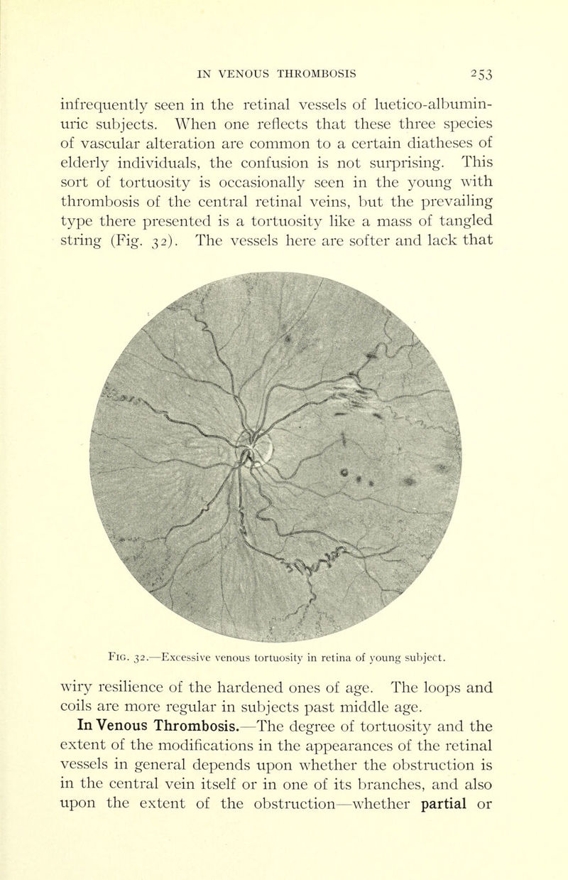 IN VENOUS THROMBOSIS infrequently seen in the retinal vessels of luetico-albumin- uric subjects. When one reflects that these three species of vascular alteration are common to a certain diatheses of elderly individuals, the confusion is not surprising. This sort of tortuosity is occasionally seen in the young with thrombosis of the central retinal veins, but the prevaiHng type there presented is a tortuosity like a mass of tangled string (Fig. 32). The vessels here are softer and lack that Fig. 32.—Excessive venous tortuosity in retina of young subject. wiry resilience of the hardened ones of age. The loops and coils are more regular in subjects past middle age. In Venous Thrombosis.—The degree of tortuosity and the extent of the modifications in the appearances of the retinal vessels in general depends upon whether the obstruction is in the central vein itself or in one of its branches, and also upon the extent of the obstruction—whether partial or