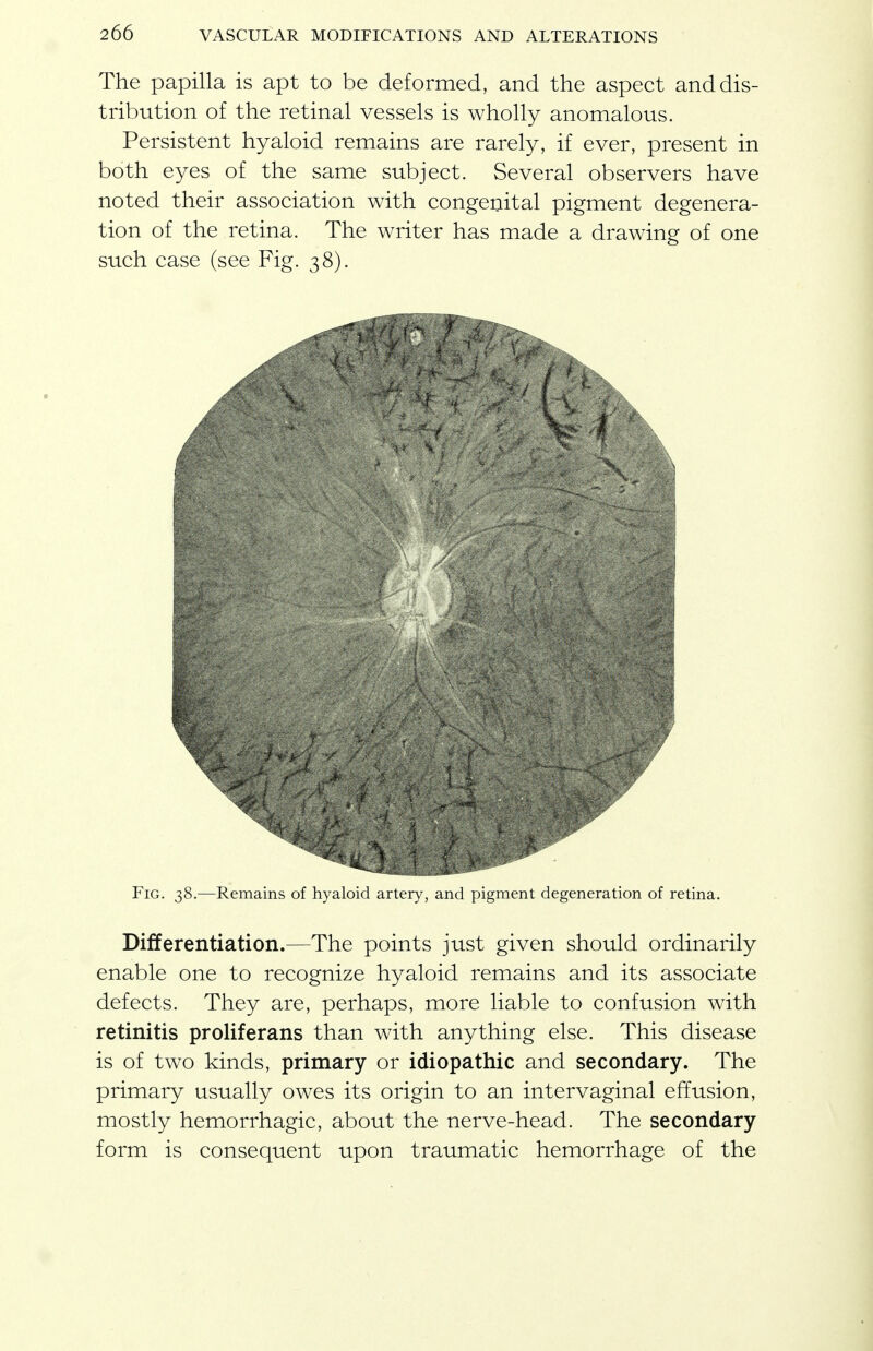 The papilla is apt to be deformed, and the aspect and dis- tribution of the retinal vessels is wholly anomalous. Persistent hyaloid remains are rarely, if ever, present in both eyes of the same subject. Several observers have noted their association with congemtal pigment degenera- tion of the retina. The writer has made a drawing of one such case (see Fig. 38). Fig. 38.—Remains of hyaloid artery, and pigment degeneration of retina. Differentiation.—The points just given should ordinarily enable one to recognize hyaloid remains and its associate defects. They are, perhaps, more liable to confusion with retinitis proliferans than with anything else. This disease is of two kinds, primary or idiopathic and secondary. The primary usually owes its origin to an intervaginal effusion, mostly hemorrhagic, about the nerve-head. The secondary form is consequent upon traumatic hemorrhage of the