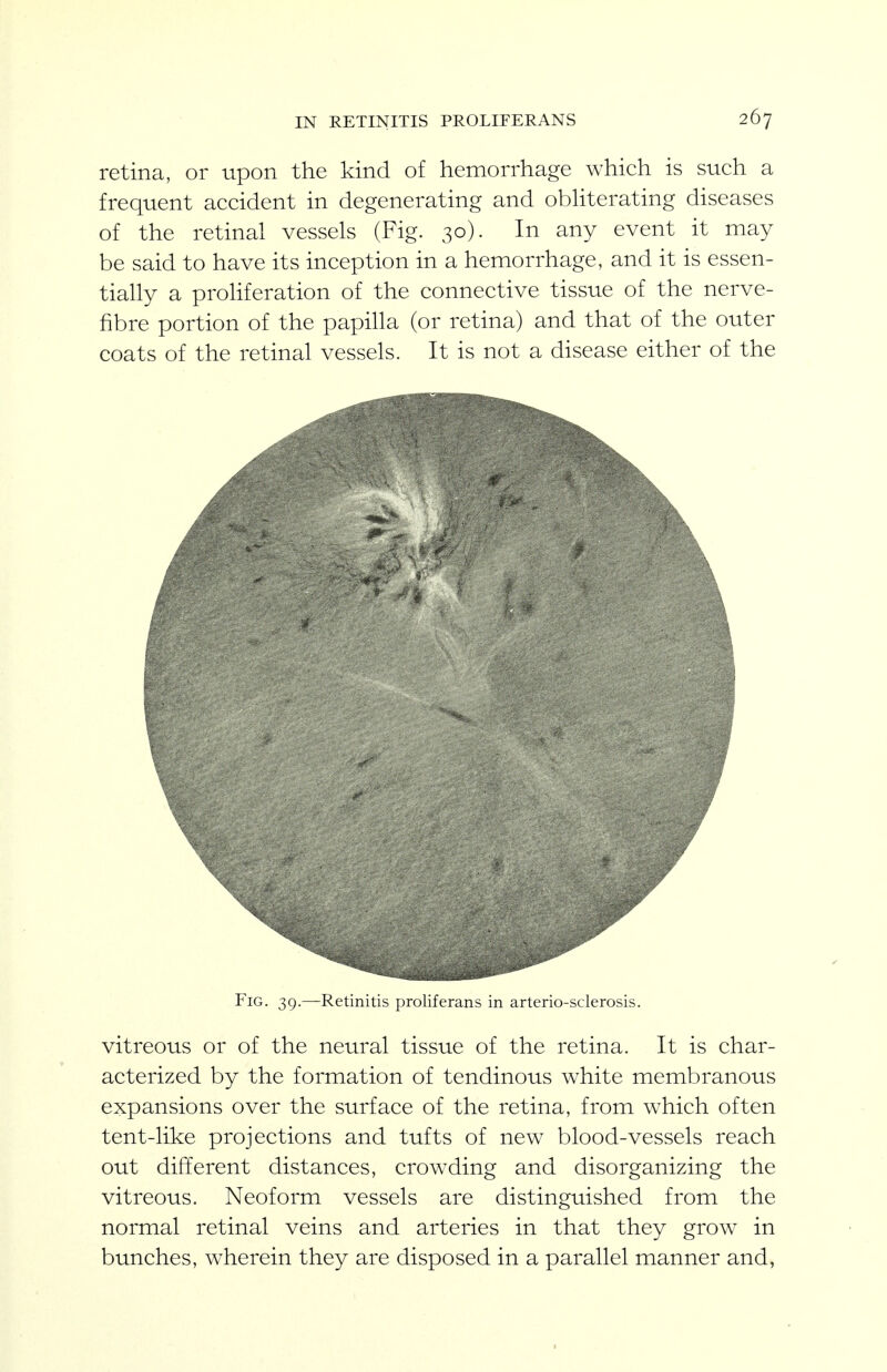 retina, or upon the kind of hemorrhage which is such a frequent accident in degenerating and obhterating diseases of the retinal vessels (Fig. 30). In any event it may be said to have its inception in a hemorrhage, and it is essen- tially a prohferation of the connective tissue of the nerve- fibre portion of the papiUa (or retina) and that of the outer coats of the retinal vessels. It is not a disease either of the Fig. 39.—Retinitis proliferans in arterio-sclerosis. vitreous or of the neural tissue of the retina. It is char- acterized by the formation of tendinous white membranous expansions over the surface of the retina, from which often tent-like projections and tufts of new blood-vessels reach out different distances, crowding and disorganizing the vitreous. Neoform vessels are distinguished from the normal retinal veins and arteries in that they grow in bunches, wherein they are disposed in a parallel manner and, I