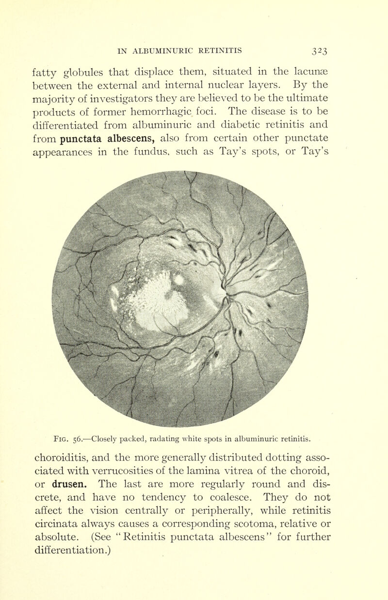 IN ALBUMINURIC RETINITIS fatty globules that displace them, situated in the lacunae between the external and internal nuclear layers. By the majority of investigators they are believed to be the ultimate products of former hemorrhagic foci. The disease is to be differentiated from albuminuric and diabetic retinitis and from punctata albescens, also from certain other punctate appearances in the fundus, such as Tay's spots, or Tay's Fig. 56.—Closely packed, radating white spots in albuminuric retinitis. choroiditis, and the more generally distributed dotting asso- ciated with verrucosities of the lamina vitrea of the choroid, or drusen. The last are more regularly round and dis- crete, and have no tendency to coalesce. Thc}^ do not affect the vision centrally or peripherally, while retinitis circinata always causes a corresponding scotoma, relative or absolute. (See Retinitis punctata albescens for farther differentiation.)