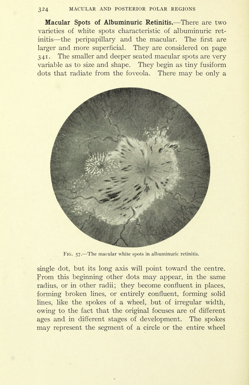 Macular Spots of Albuminuric Retinitis.—There are two varieties of white spots characteristic of albuminuric ret- initis—the peripapillary and the macular. The first are larger and more superficial. They are considered on page 341. The smaller and deeper seated macular spots are very variable as to size and shape. They begin as tiny fusiform dots that radiate from the foveola. There may be only a Fig. 57.—The macular white spots in albuminuric retinitis. single dot, but its long axis will point toward the centre. From this beginning other dots may appear, in the same radius, or in other radii; they become confluent in places, forming broken lines, or entirely confluent, forming solid lines, like the spokes of a wheel, but of irregular width, owing to the fact that the original focuses are of different ages and in different stages of development. The spokes may represent the segment of a circle or the entire wheel