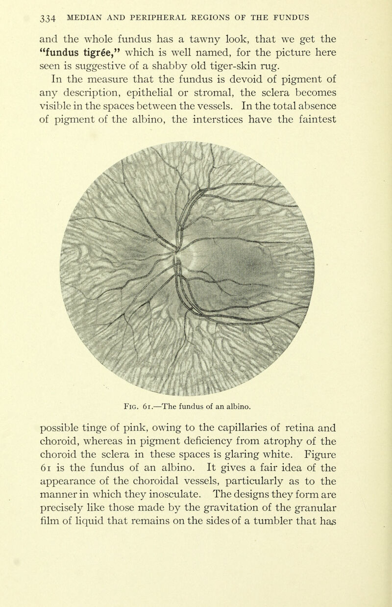 and the whole fundus has a tawny look, that we get the fundus tigree,*' which is well named, for the picture here seen is suggestive of a shabby old tiger-skin rug. In the measure that the fundus is devoid of pigment of any description, epithelial or stromal, the sclera becomes visible in the spaces between the vessels. In the total absence of pigment of the albino, the interstices have the faintest Fig. 6i.—The fundus of an albino. possible tinge of pink, owing to the capillaries of retina and choroid, whereas in pigment deficiency from atrophy of the choroid the sclera in these spaces is glaring white. Figure 61 is the fundus of an albino. It gives a fair idea of the appearance of the choroidal vessels, particularly as to the manner in which they inosculate. The designs they form are precisely like those made by the gravitation of the granular film of liquid that remains on the sides of a tumbler that has