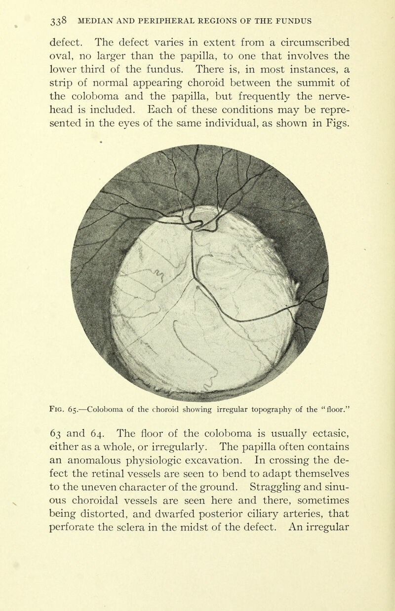 defect. The defect varies in extent from a circumscribed oval, no larger than the papilla, to one that involves the lower third of the fundus. There is, in most instances, a strip of normal appearing choroid between the summit of the coloboma and the papilla, but frequently the nerve- head is included. Each of these conditions may be repre- sented in the eyes of the same individual, as shown in Figs. Fig. 65.—Coloboma of the choroid showing irregular topography of the floor. 63 and 64. The floor of the coloboma is usually ectasic, either as a whole, or irregularly. The papilla often contains an anomalous physiologic excavation. In crossing the de- fect the retinal vessels are seen to bend to adapt themselves to the uneven character of the ground. Straggling and sinu- ous choroidal vessels are seen here and there, sometimes being distorted, and dwarfed posterior ciliary arteries, that perforate the sclera in the midst of the defect. An irregular