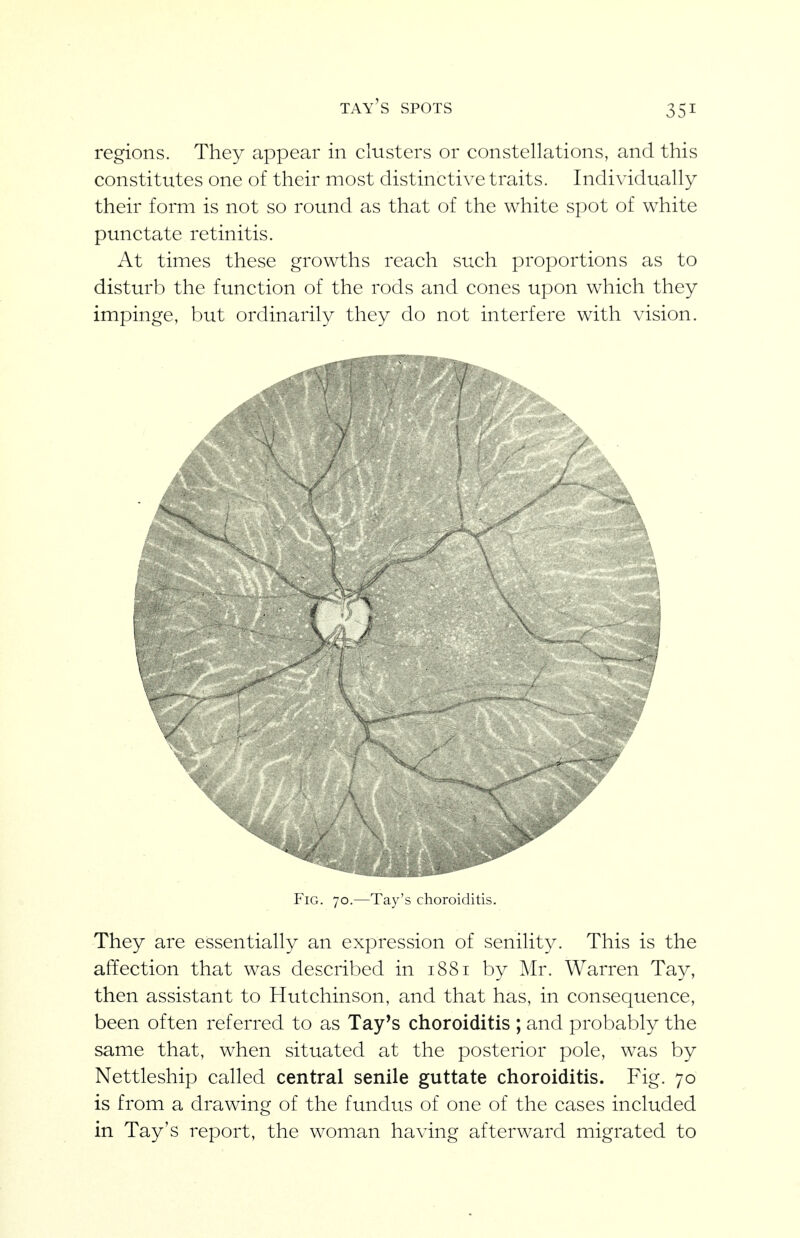 tay's spots regions. They appear in clusters or constellations, and this constitutes one of their most distinctive traits. Individually their form is not so round as that of the white spot of white punctate retinitis. At times these growths reach such proportions as to disturb the function of the rods and cones upon which they impinge, but ordinarily they do not interfere with vision. Fig. 70.—Tay's choroiditis. They are essentially an expression of senility. This is the affection that was described in 1881 by Mr. Warren Tay, then assistant to Hutchinson, and that has, in consequence, been often referred to as Tay's choroiditis ; and probably the same that, when situated at the posterior pole, was by Nettleship called central senile guttate choroiditis. Fig. 70 is from a drawing of the fundus of one of the cases included in Tay's report, the woman having afterward migrated to