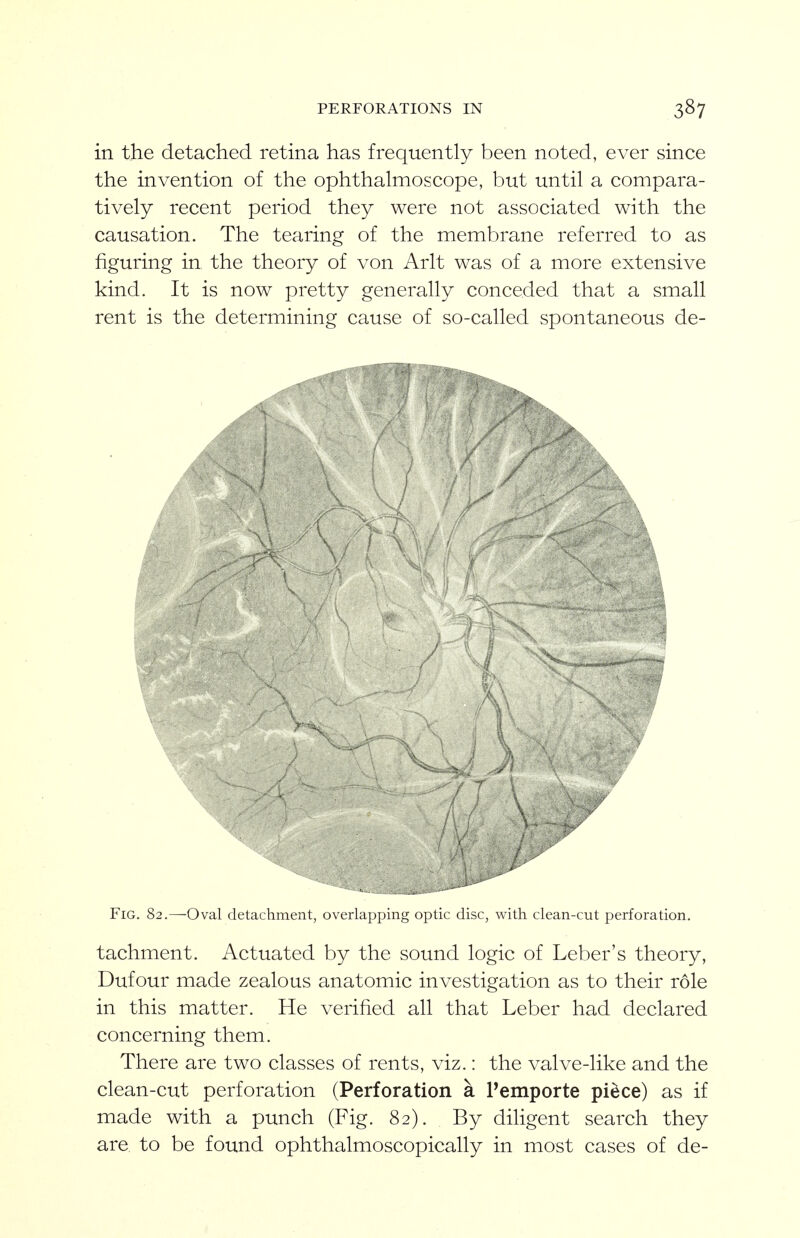 in the detached retina has frequently been noted, ever since the invention of the ophthalmoscope, but until a compara- tively recent period they were not associated with the causation. The tearing of the membrane referred to as figuring in the theory of von Arlt was of a more extensive kind. It is now pretty generally conceded that a small rent is the determining cause of so-called spontaneous de- FiG. 82.—Oval detachment, overlapping optic disc, v^ith clean-cut perforation. tachment. Actuated by the sound logic of Leber's theory, Dufour made zealous anatomic investigation as to their role in this matter. He verified all that Leber had declared concerning them. There are two classes of rents, viz.: the valve-like and the clean-cut perforation (Perforation a Pemporte piece) as if made with a punch (Fig. 82). By diligent search they are. to be found ophthalmoscopically in most cases of de-