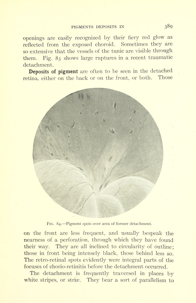 PIGMENTS DEPOSITS IN Openings are easily recognized by their fiery red glow as reflected from the exposed choroid. Sometimes they are so extensive that the vessels of the tunic are visible through them. Fig. 83 shows large ruptures in a recent traumatic detachment. Deposits of pigment are often to be seen in the detached retina, either on the back or on the front, or both. Those Fig. 84.—Pigment spots over area of former detachment. on the front are less frequent, and usually bespeak the nearness of a perforation, through which they have found their way. They are all inclined to circularity of outline; those in front being intensely black, those behind less so. The retro-retinal spots evidently were integral parts of the focuses of chorio-retinitis before the detachment occurred. The detachment is frequently traversed in places by white stripes, or striae. They bear a sort of parallelism to