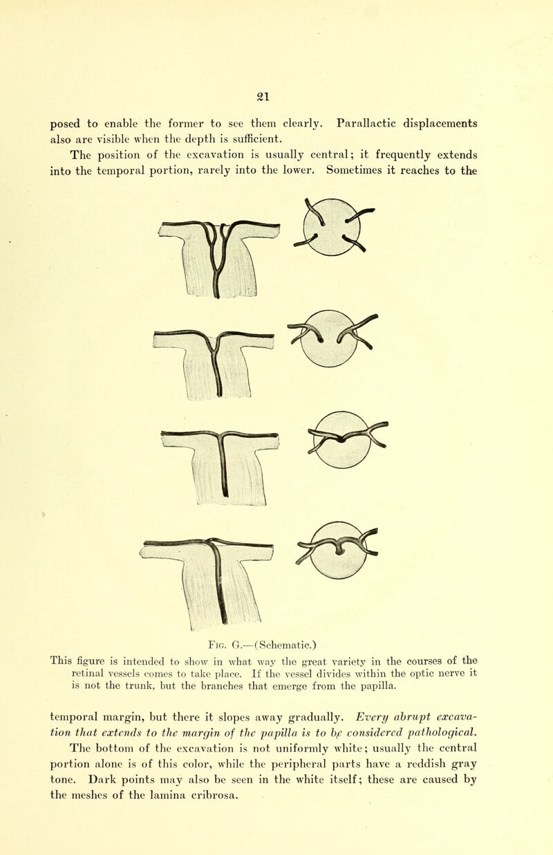 posed to enable the former to see them clearly. Parallactic displacements also are visible when the depth is sufficient. The position of the excavation is usually central; it frequently extends into the temporal portion, rarely into the lower. Sometimes it reaches to the Fjg. G.—(Schematic.) This figure is intended to show in what way the great variety in the courses of the retinal vessels comes to take place. If the vessel divides Avithin the optic nerve it is not the trunk, but the branches that emerge from the papilla. temporal margin, but there it slopes away gradually. Every abrupt excava- tion that extends to the margin of the papilla is to bf considered pathological. The bottom of the excavation is not uniformly white; usually the central portion alone is of this color, while the peripheral parts have a reddish gray tone. Dark points may also be seen in the white itself; these are caused by the meshes of the lamina cribrosa.