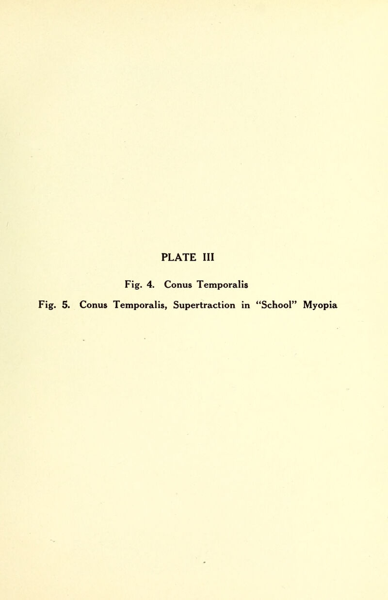 Fig. 4. Conus Temporalis Fig. 5. Conus Temporalis, Supertraction in School Myopia