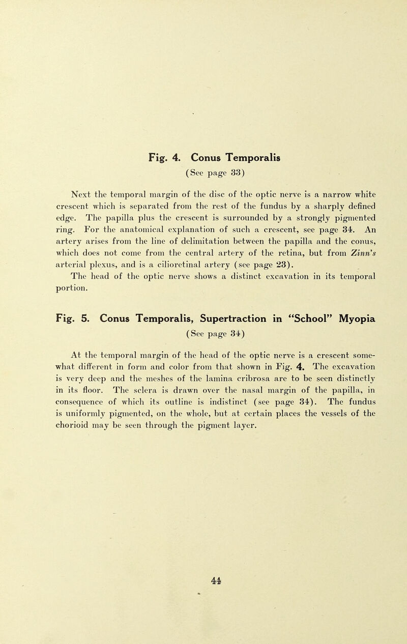 (See page 33) Next the temporal margin of the disc of the optic nerve is a narrow white crescent which is separated from the rest of the fundus by a sharply defined edge. The papilla plus the crescent is surrounded by a strongly pigmented ring. For the anatomical explanation of such a crescent, see page 34. An artery arises from the line of delimitation between the papilla and the conus, which does not come from the central artery of the retina, but from Zinn's arterial plexus, and is a cilioretinal artery (see page 23). The head of the optic nerve shows a distinct excavation in its temporal portion. Fig. 5. Conus Temporalis, Supertraction in School Myopia (See page 34) At the temporal margin of the head of the optic nerve is a crescent some- what different in form and color from that shown in Fig. 4. The excavation is very deep and the meshes of the lamina cribrosa are to be seen distinctly in its floor. The sclera is drawn over the nasal margin of the papilla, in consequence of which its outline is indistinct (see page 34). The fundus is uniformly pigmented, on the whole, but at certain places the vessels of the chorioid may be seen through the pigment layer.