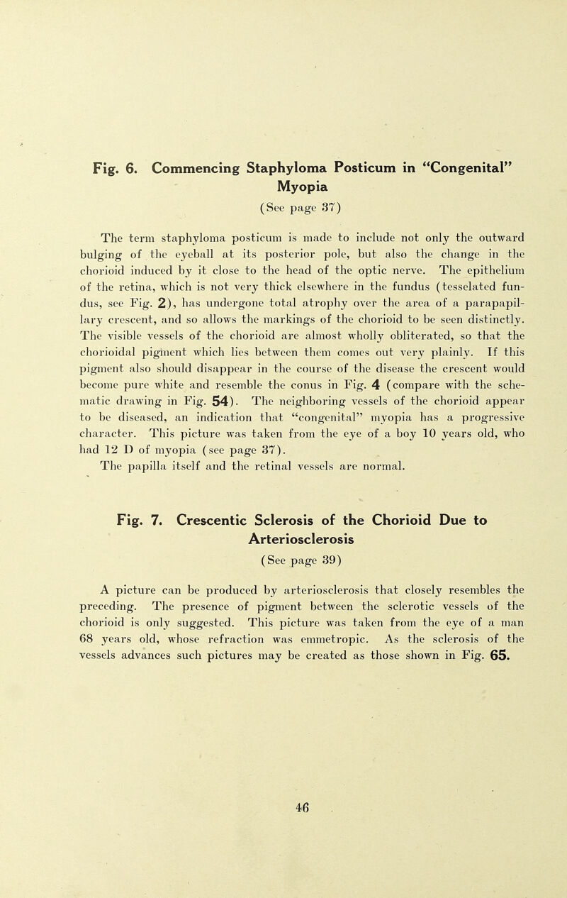 Myopia (See page 37) The term staphyloma posticum is made to include not only the outward bulging of the eyeball at its posterior pole, but also the change in the chorioid induced by it close to the head of the optic nerve. The epithelium of the retina, which is not very thick elsewhere in the fundus (tesselated fun- dus, see Fig. 2), has undergone total atrophy over the area of a parapapil- lary crescent, and so allows the markings of the chorioid to be seen distinctly. The visible vessels of the chorioid are almost wholly obliterated, so that the chorioidal piginent which lies between them comes out very plainly. If this pigment also should disappear in the course of the disease the crescent would become pure white and resemble the conus in Fig. 4 (compare with the sche- matic drawing in Fig. 54). The neighboring vessels of the chorioid appear to be diseased, an indication that congenital myopia has a progressive character. This picture was taken from the eye of a boy 10 years old, who had 12 D of myopia (see page 37). The papilla itself and the retinal vessels are normal. Fig. 7. Crescentic Sclerosis of the Chorioid Due to Arteriosclerosis (See page 39) A picture can be produced by arteriosclerosis that closely resembles the preceding. The presence of pigment between the sclerotic vessels of the chorioid is only suggested. This picture was taken from the eye of a man 68 years old, whose refraction was emmetropic. As the sclerosis of the vessels advances such pictures may be created as those shown in Fig. 65. 46