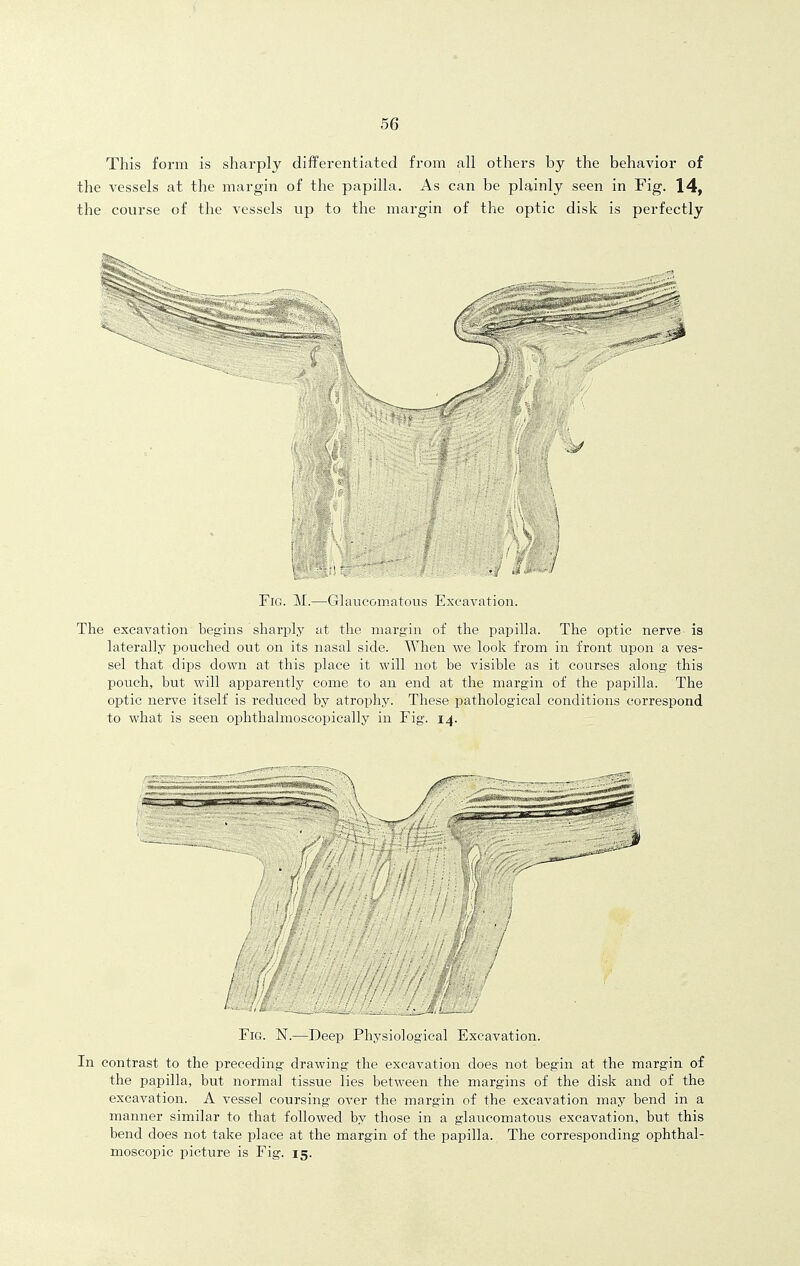 This form is sharply differentiated from all others by the behavior of the vessels at the margin of the papilla. As can be plainly seen in Fig. 14, the course of the vessels up to the margin of the optic disk is perfectly Fig. M.—Glaucomatous Excavation. The excavation begins sharply at the margin of the papilla. The optic nerve is laterally pouched out on its nasal side. When we look from in front upon a ves- sel that dips down at this place it will not be visible as it courses along this pouch, but will apparently come to an end at the margin of the papilla. The optic nerve itself is reduced by atrophy. These pathological conditions correspond to what is seen ophtlialmoscopically in Fig. 14. Fig. N.—Deep Physiological Excavation. In contrast to the preceding drawing the excavation does not begin at the margin of the papilla, but normal tissue lies between the margins of the disk and of the excavation. A vessel coursing over the margin of the excavation may bend in a manner similar to that followed by those in a glaucomatous excavation, but this bend does not take place at the margin of the papilla. The corresponding ophthal- moscopic picture is Fig. 15.