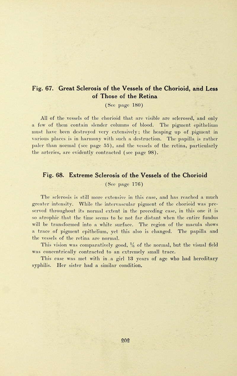 of Those of the Retina (See page 180) All of the vessels of the chorioid that are visible are sclerosed, and only a few of them contain slender columns of blood. The pigment epithelium must have been destroyed very extensively; the heaping up of pigment in various places is in harmony with such a destruction. The papilla is rather paler than normal (see page 55), and the vessels of the retina, particularly the arteries, are evidently contracted (see page 98). Fig. 68. Extreme Sclerosis of the Vessels of the Chorioid (See page 176) The sclerosis is still more extensive in this case, and has reached a much greater intensity. While the intervascular pigment of the chorioid was pre- served throughout its normal extent in the preceding case, in this one it is so atrophic that the time seems to be not far distant when the entire fundus will be transformed into a white surface. The region of the macula shows a trace of pigment epithelium, yet this also is changed. The papilla and the vessels of the retina are normal. This vision was comparatively good, Ve of the normal, but the visual field was concentrically contracted to an extremely small trace. This case was met with in a girl 13 years of age who had hereditary syphilis. Her sister had a similar condition. SOS