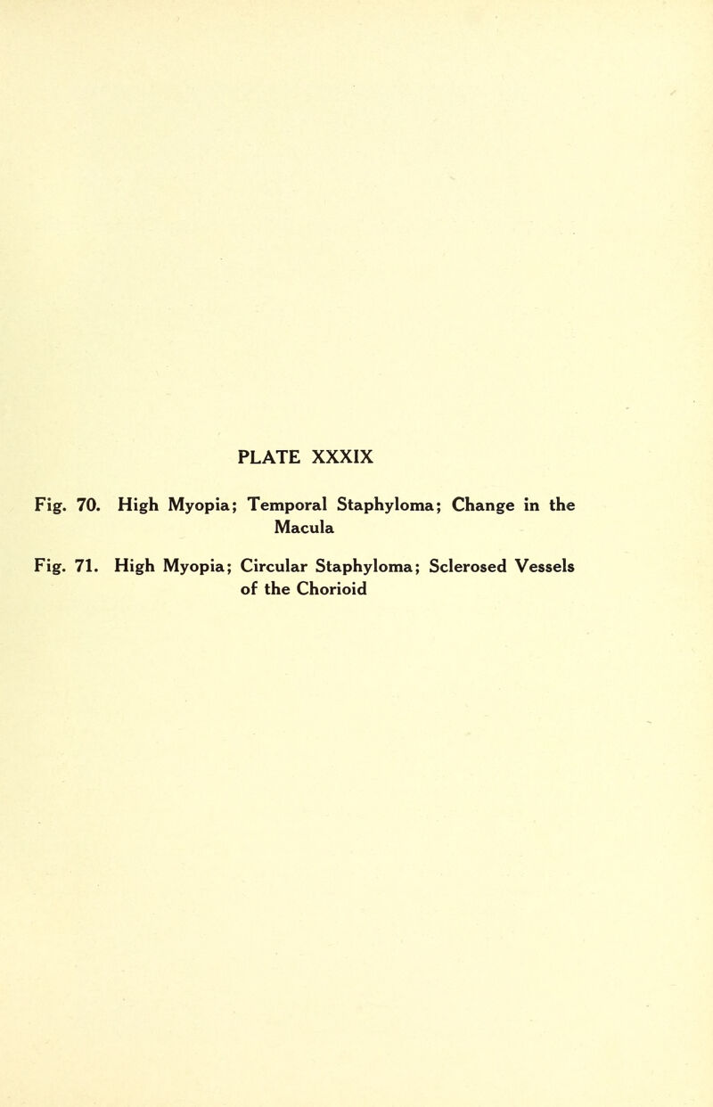 Fig. 70. High Myopia; Temporal Staphyloma; Change in the Macula Fig. 71. High Myopia; Circular Staphyloma; Sclerosed Vessels of the Chorioid
