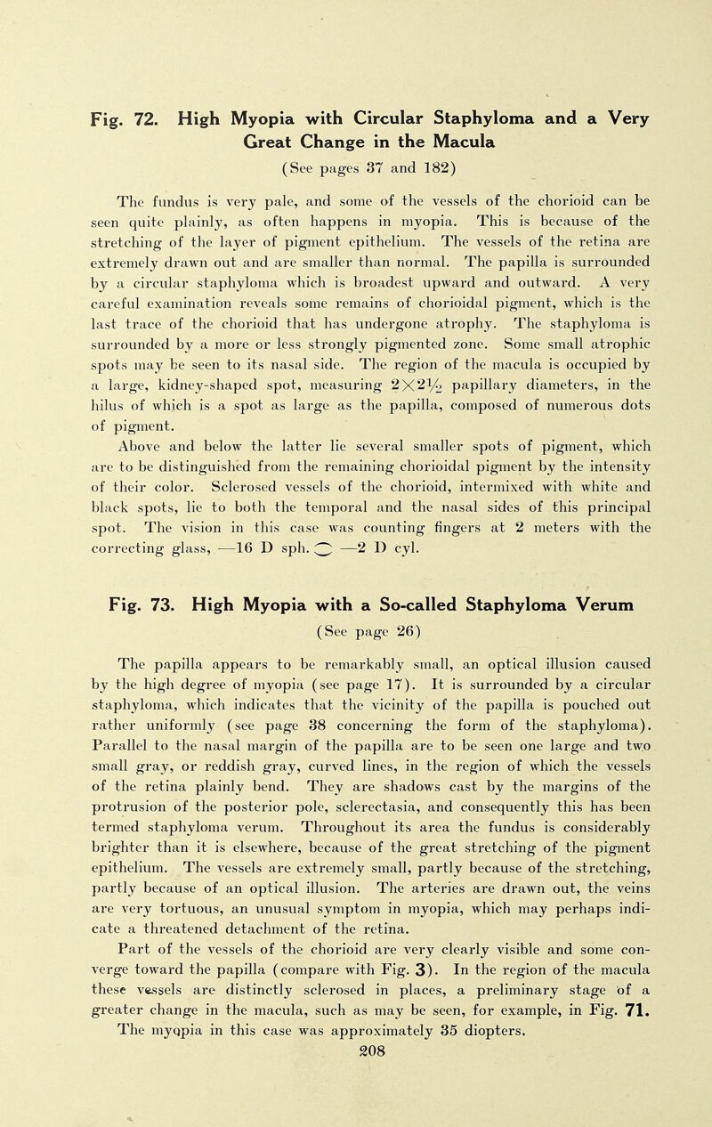 Fig. 72. High Myopia with Circular Staphyloma and a Very Great Change in the Macula (See pages 37 and 182) The fundus is very pale, and some of the vessels of the chorioid can be seen quite plainly, as often happens in myopia. This is because of the stretching of the layer of pigment epithelium. The vessels of the retina are extremely drawn out and are smaller than normal. The papilla is surrounded by a circular staphyloma which is broadest upward and outward. A very careful examination reveals some remains of chorioidal pigment, which is the last trace of the chorioid that has undei-gone atrophy. The staphyloma is surrounded by a more or less strongly pigmented zone. Some small atrophic spots may be seen to its nasal side. The region of the macula is occupied by a large, kidney-shaped spot, measuring 2X2^ papillary diameters, in the hilus of which is a spot as large as the papilla, composed of numerous dots of pigment. Above and below the latter lie several smaller spots of pigment, which are to be distinguished from the remaining chorioidal pigment by the intensity of their color. Sclerosed vessels of the chorioid, intermixed with white and black spots, lie to both the temporal and the nasal sides of this principal spot. The vision in this case was counting fingers at 2 meters with the correcting glass, —16 D sph. —2 D cyl. Fig. 73. High Myopia with a So-called Staphyloma Verum (See page 26) The papilla appears to be remarkably small, an optical illusion caused by the high degree of myopia (see page 17). It is surrounded by a circular staphyloma, which indicates that the vicinity of the papilla is pouched out rather uniformly (see page 38 concerning the form of the staphyloma). Parallel to the nasal margin of the papilla are to be seen one large and tw:o small gray, or reddish gray, curved lines, in the region of which the vessels of the retina plainly bend. They are shadows cast by the margins of the protrusion of the posterior pole, sclerectasia, and consequently this has been termed staphyloma verum. Throughout its area the fundus is considerably brighter than it is elsewhere, because of the great stretching of the pigment epithelium. The vessels are extremely small, partly because of the stretching, partly because of an optical illusion. The arteries are drawn out, the veins are very tortuous, an unusual symptom in myopia, which may perhaps indi- cate a threatened detachment of the retina. Part of the vessels of the chorioid are very clearly visible and some con- verge toward the papilla (compare with Fig. 3). In the region of the macula these vessels are distinctly sclerosed in places, a preliminary stage of a greater change in the macula, such as may be seen, for example, in Fig. 71. The myqpia in this case was approximately 35 diopters. 208