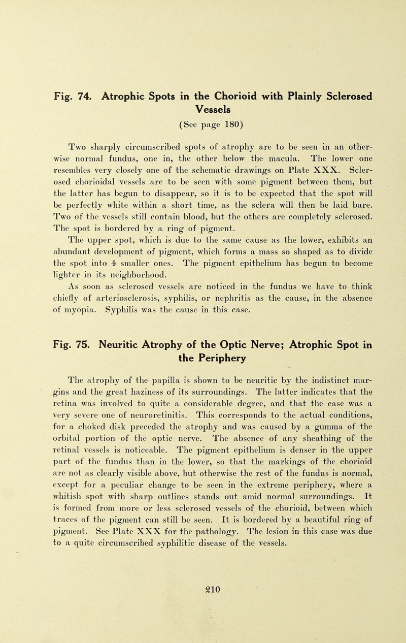 Fig. 74. Atrophic Spots in the Chorioid with Plainly Sclerosed Vessels (See page 180) Two sharply circumscribed spots of atrophy are to be seen in an other- wise normal fundus, one in, the other below the macula. The lower one resembles very closely one of the schematic drawings on Plate XXX. Scler- osed chorioidal vessels are to be seen with some pigment between them, but the latter has begun to disappear, so it is to be expected that the spot will be perfectly white within a short time, as the sclera will then be laid bare. Two of the vessels still contain blood, but the others are completely sclerosed. The spot is bordered by a ring of pigment. The upper spot, which is due to the same cause as the lower, exhibits an abundant development of pigment, which forms a mass so shaped as to divide the spot into 4 smaller ones. The pigment epithelium has begun to become lighter in its neighborhood. As soon as sclerosed vessels are noticed in the fundus we have to think chiefly of arteriosclerosis, syphilis, or nephritis as the cause, in the absence of myopia. Syphilis was the cause in this case. Fig. 75. Neuritic Atrophy of the Optic Nerve; Atrophic Spot in the Periphery The atrophy of the papilla is shown to be neuritic by the indistinct mar- gins and the great haziness of its surroundings. The latter indicates that the retina was involved to quite a considerable degree, and that the case was a very severe one of neuroretinitis. This corresponds to the actual conditions, for a choked disk preceded the atrophy and was caused by a gumma of the orbital portion of the optic nerve. The absence of any sheathing of the retinal vessels is noticeable. The pigment epithelium is denser in the upper part of the fundus than in the lower, so that the markings of the chorioid are not as clearly visible above, but otherwise the rest of the fundus is normal, except for a peculiar change to be seen in the extreme periphery, where a whitish spot with sharp outlines stands out amid normal surroundings. It is formed from more or less sclerosed vessels of the chorioid, between which traces of the pigment can still be seen. It is bordered by a beautiful ring of pigment. See Plate XXX for the pathology. The lesion in this case was due to a quite circumscribed syphilitic disease of the vessels. 210