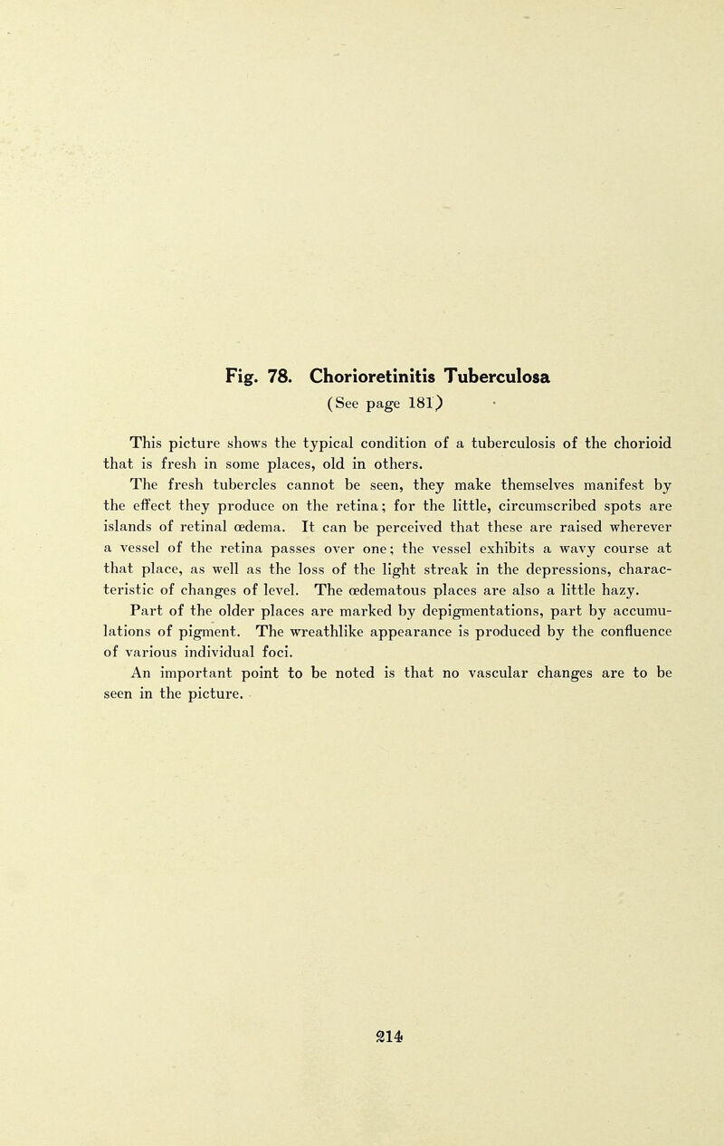 (See page 181) This picture shows the typical condition of a tuberculosis of the chorioid that is fresh in some places, old in others. The fresh tubercles cannot be seen, they make themselves manifest by the effect they produce on the retina; for the little, circumscribed spots are islands of retinal oedema. It can be perceived that these are raised wherever a vessel of the retina passes over one; the vessel exhibits a wavy course at that place, as well as the loss of the light streak in the depressions, charac- teristic of changes of level. The oedematous places are also a little hazy. Part of the older places are marked by depigmentations, part by accumu- lations of pigment. The wreathlike appearance is produced by the confluence of various individual foci. An important point to be noted is that no vascular changes are to be seen in the picture. 214