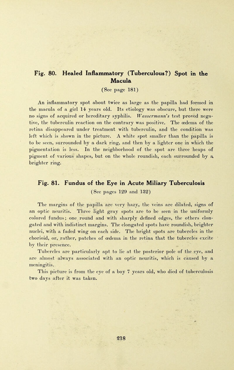 Macula (See page 181) An inflammatory spot about twice as large as the papilla had formed in the macula of a girl 14 years old. Its etiology was obscure, but there were no signs of acquired or hereditary syphilis. Wassermann's test proved nega- tive, the tuberculin reaction on the contrary was positive. The oedema of the retina disappeared under treatment with tuberculin, and the condition was left which is shown in the picture. A white spot smaller than the papilla is to be seen, surrounded by a dark ring, and then by a lighter one in which the pigmentation is less. In the neighborhood of the spot are three heaps of pigment of various shapes, but on the whole roundish, each surrounded by a, brighter ring. Fig. 81. Fundus of the Eye in Acute Miliary Tuberculosis (See pages 129 and 132) The margins of the papilla are very hazy, the veins are dilated, signs of an optic neuritis. Three light gray spots are to be seen in the uniformly colored fundus; one round and with sharply defined edges, the others elon- gated and with indistinct margins. The elongated spots have roundish, brighter nuclei, with a faded wing on each side. The bright spots are tubercles in the chorioid, or, rather, patches of oedema in the retina that the tubercles excite by their presence. Tubercles are particularly apt to lie at the posterior pole of the eye, and are almost always associated with an optic neuritis, which is caused by a meningitis. This picture is from the eye of a boy 7 years old, who died of tuberculosis two days after it was taken. 218