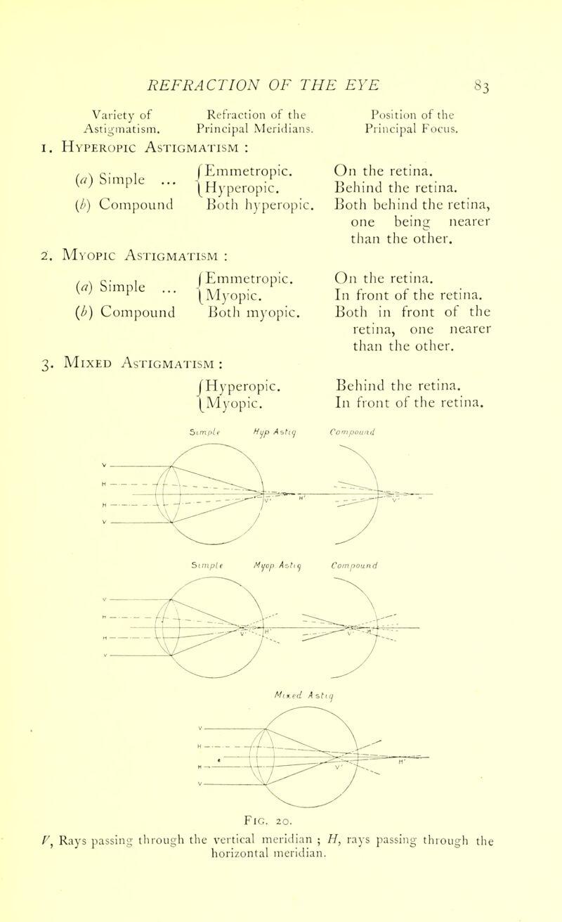 Variety of Refraction of the Astigmatism. Principal Meridians. Hyperopic Astigmatism : (a) Simple ... (b) Compound I Emmetropic. ^Hyperopic. Both hyperopic. 2. Mvopic Astigmatism : {a) Simple (b) Compound (Emmetropic. {Myopic. Both myopic. 3. Mixed Astigmatism JHyperopic. (^Myopic. Position of the Principal Focus. On the retina. Behind the retina. Both behind the retina, one being nearer than the other. On the retina. In front of the retina. Both in front of the retina, one nearer than the other. Behind the retina. In front of the retina. 5tmp/f Hup A sfiy Compound Fig. 20. f, Rays passing through the vertical meridian j H, rays passing through the horizontal meridian.