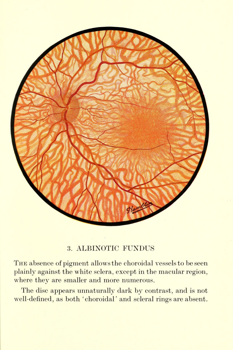 3. ALBINOTIC FUNDUS The absence of pigment allows the choroidal vessels to be seen plainly against the white sclera, except in the macular region, where they are smaller and more numerous. The disc appears unnaturally dark by contrast, and is not well-defined, as both 'choroidal' and scleral rings are absent.