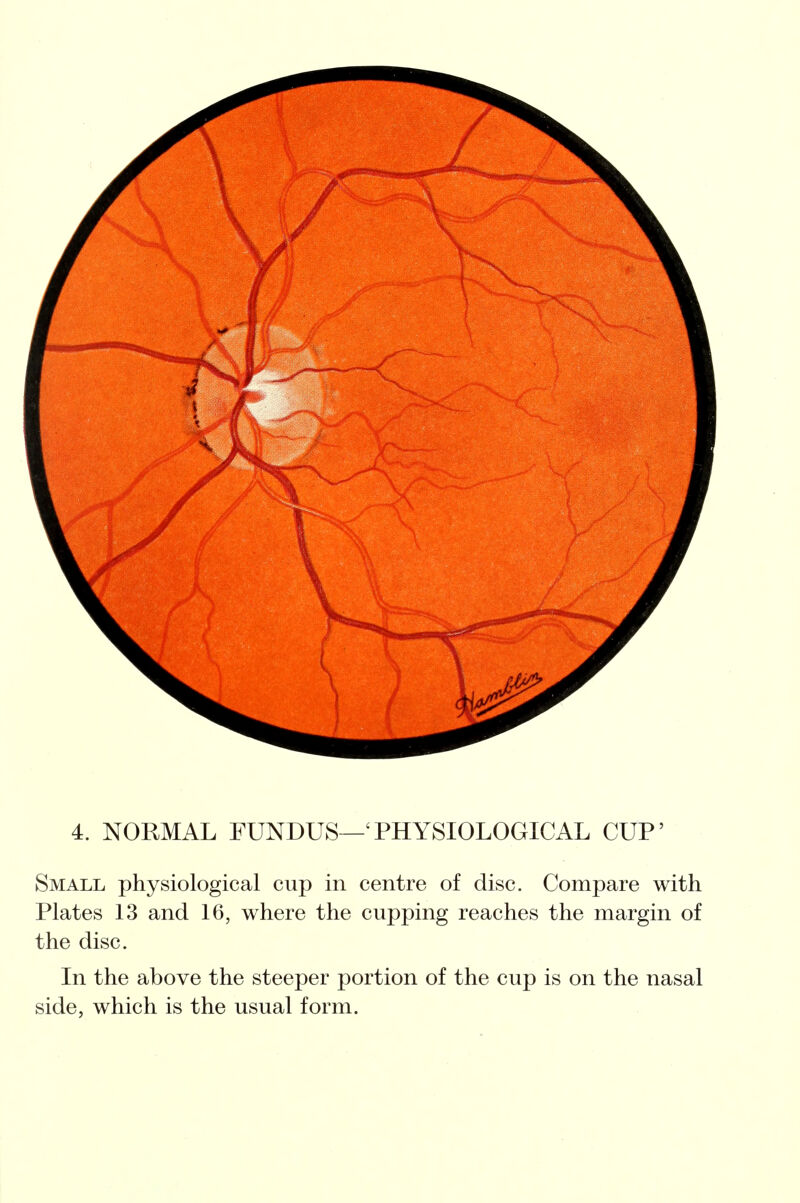 4. NORMAL FUNDUS—'PHYSIOLOGICAL CUP' Small physiological cup in centre of disc. Compare with Plates 13 and 16, where the cupping reaches the margin of the disc. In the above the steeper portion of the cup is on the nasal side, which is the usual form.