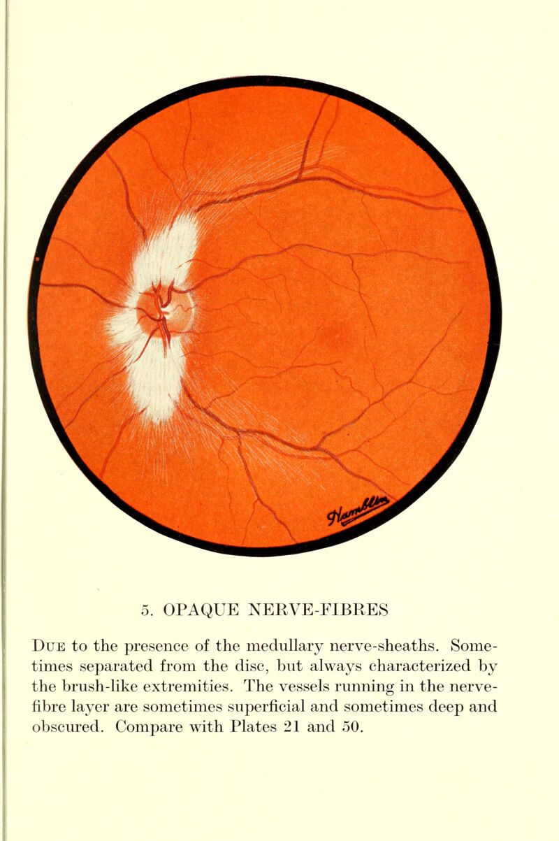 5. OPAQUE NERVE-FIBRES Due to the presence of the medullary nerve-sheaths. Some- times separated from the disc, but always characterized by the brush-like extremities. The vessels running in the nerve- fibre layer are sometimes superficial and sometimes deep and obscured. Compare with Plates 21 and 50.