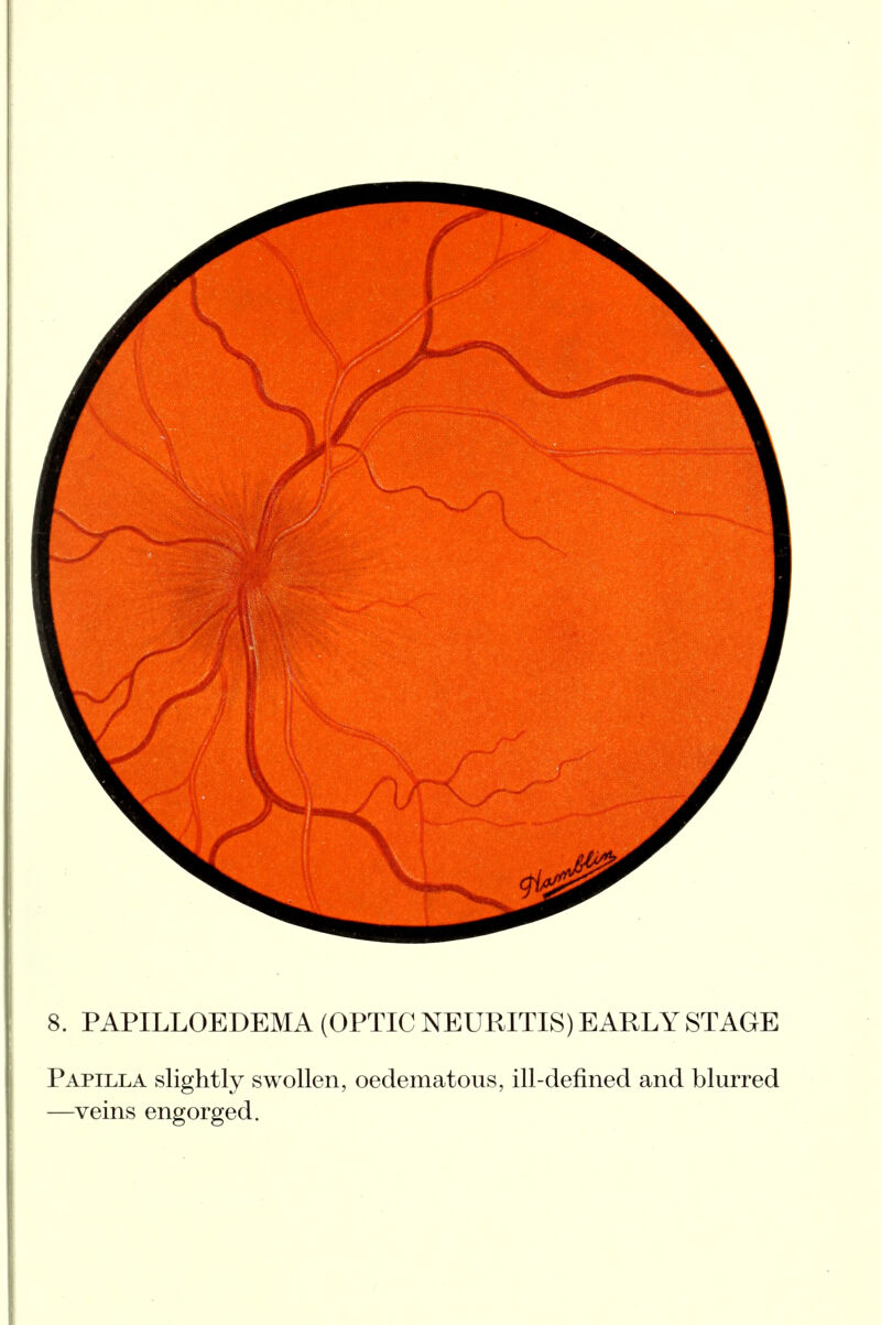 Papilla slightly swollen, oedematous, ill-defined and blurred —veins engorged.