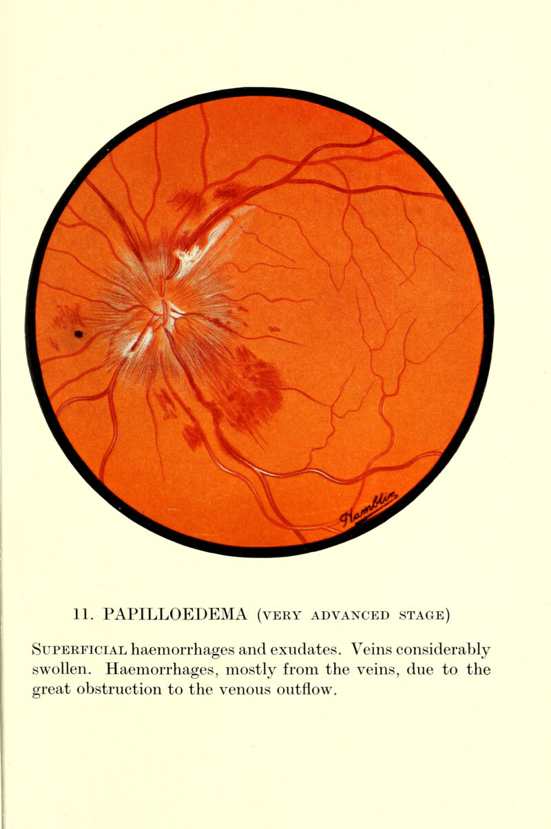 11. PAPILLOEDEMA (very advanced stage) Superficial haemorrhages and exudates. Veins considerably swollen. Haemorrhages, mostly from the veins, due to the great obstruction to the venous outflow.