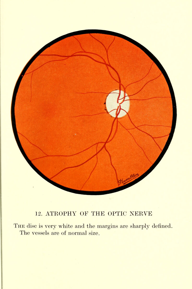 12. ATROPHY OF THE OPTIC NERVE The disc is very white and the margins are sharply defined. The vessels are of normal size.