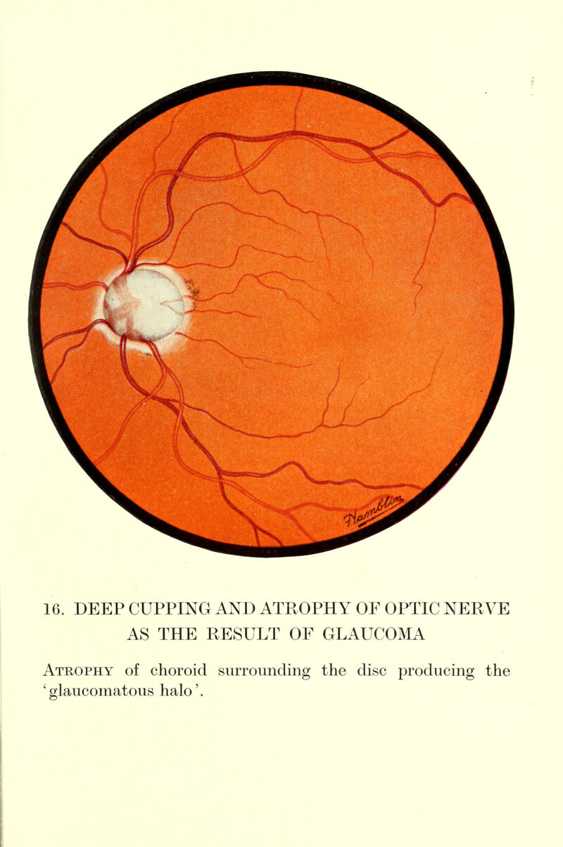 16. DEEP CUPPING AND ATROPHY OF OPTIC NERVE AS THE RESULT OF GLAUCOMA Atrophy of choroid surrounding the disc producing the ' glaucomatous halo'.