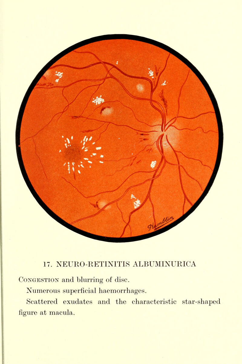 17. NEURO-RETINITIS ALBUMINURICA Congestion and blurring of disc. Numerous superficial haemorrhages. Scattered exudates and the characteristic star-shaped figure at macula.