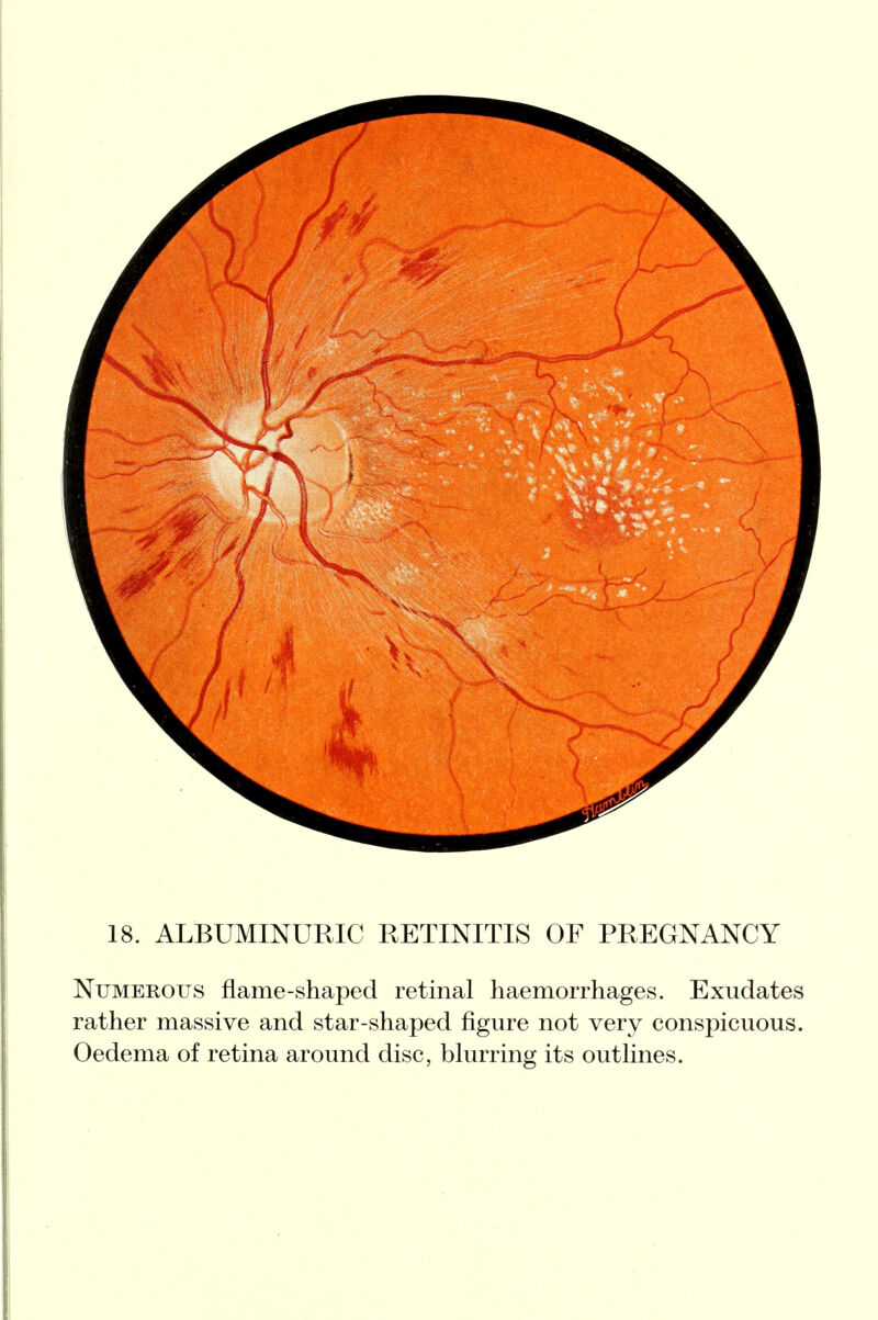 18. ALBUMINURIC RETINITIS OF PREGNANCY Numerous flame-shaped retinal haemorrhages. Exudates rather massive and star-shaped figure not very conspicuous. Oedema of retina around disc, blurring its outlines.