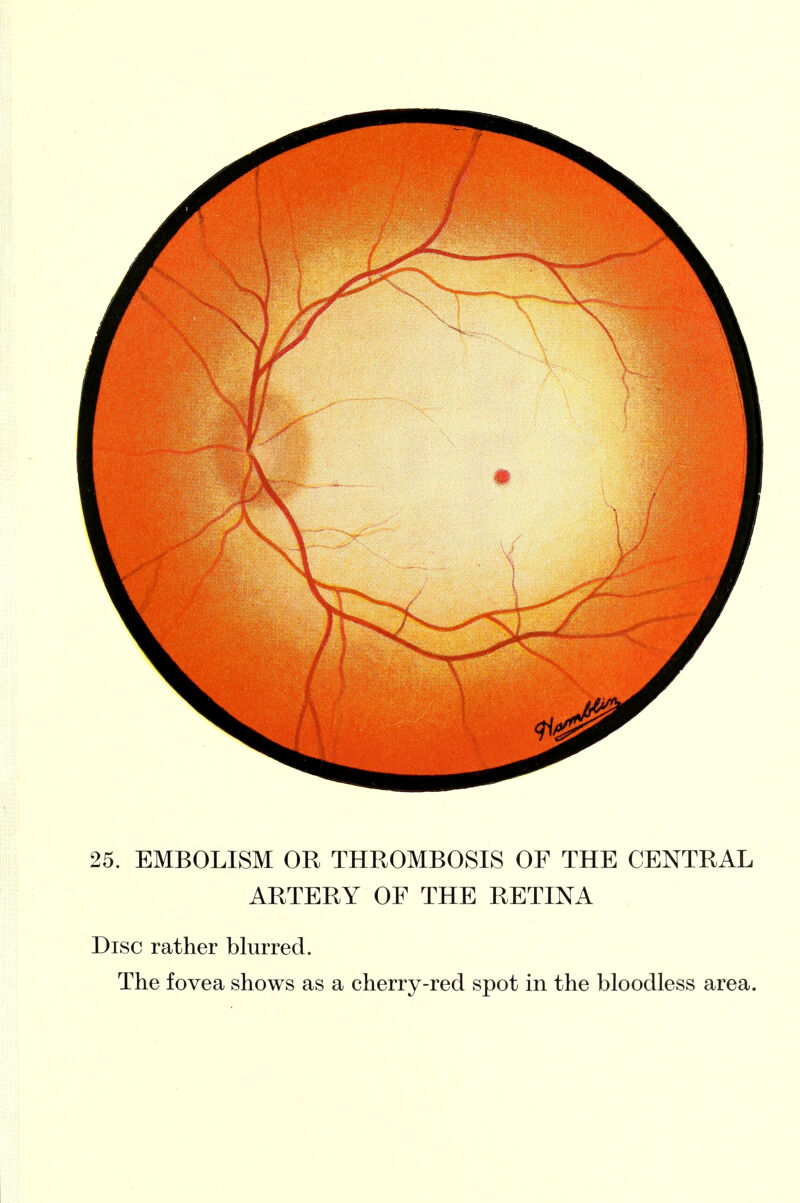 Disc rather blurred. The fovea shows as a cherry-red spot in the bloodless area.
