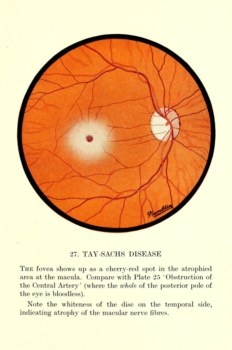 The fovea shows up as a cherry-red spot in the atrophied area at the macula. Compare with Plate 25 'Obstruction of the Central Artery' (where the whole of the posterior pole of the eye is bloodless). Note the whiteness of the disc on the temporal side, indicating atrophy of the macular nerve fibres.