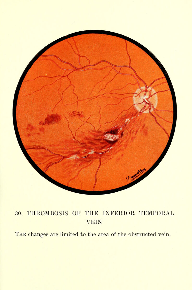 30. THROMBOSIS OF THE INFERIOR TEMPORAL VEIN The changes are limited to the area of the obstructed vein.