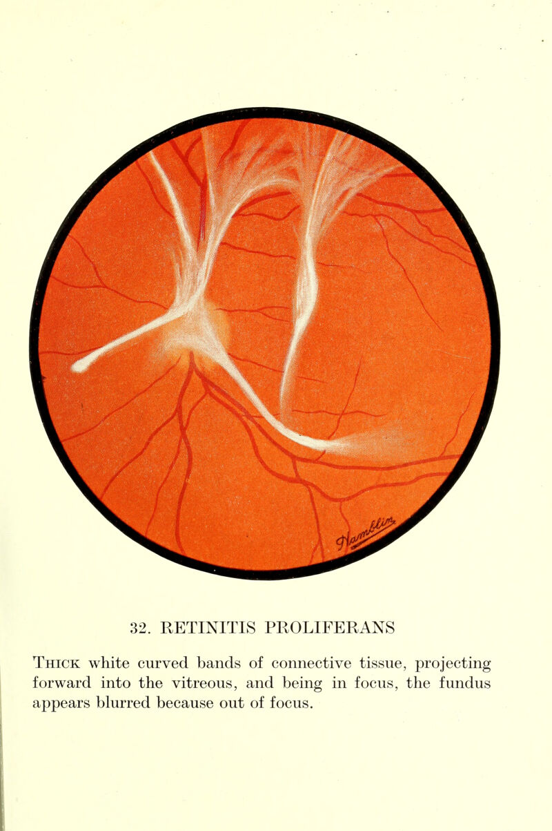 32. RETINITIS PROLIFERANS Thick white curved bands of connective tissue, projecting forward into the vitreous, and being in focus, the fundus appears blurred because out of focus.