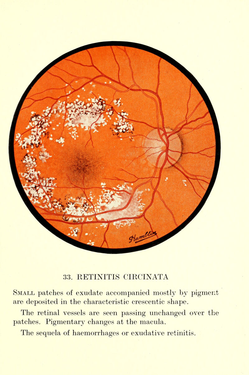 33. RETINITIS CIRCINATA Small patches of exudate accompanied mostly by pigment are deposited in the characteristic crescentic shape. The retinal vessels are seen passing unchanged over the patches. Pigmentary changes at the macula. The sequela of haemorrhages or exudative retinitis.