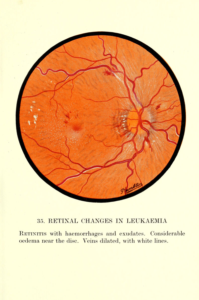 35. RETINAL CHANGES IN LEUKAEMIA Retinitis with haemorrhages and exudates. Considerable oedema near the disc. Veins dilated, with white lines.