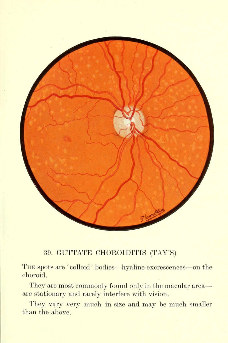 39. GUTTATE CHOROIDITIS (TAY'S) The spots are ' colloid' bodies—hyaline excrescences—on the choroid. They are most commonly f omid only in the macular area— are stationary and rarely interfere with vision. They vary very much in size and may be much smaller than the above.