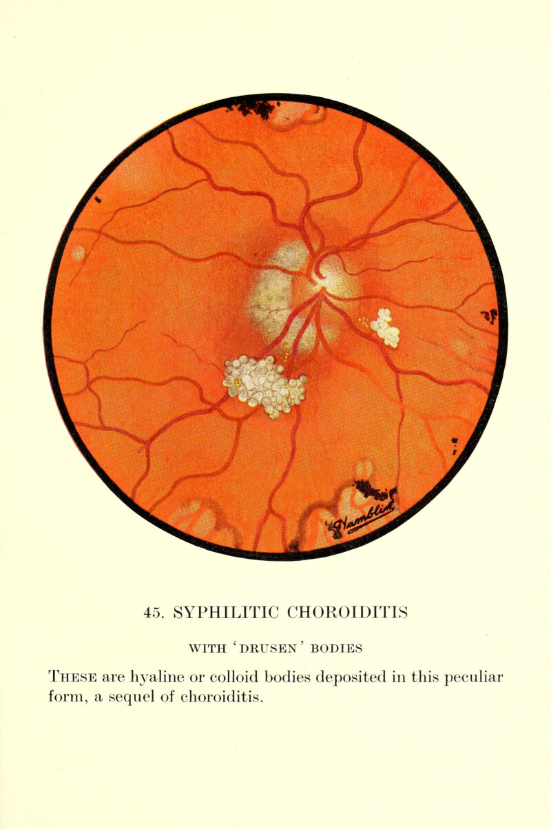 WITH 'dRUSEN' bodies These are hyaline or colloid bodies deposited in this peculiar form, a sequel of choroiditis.