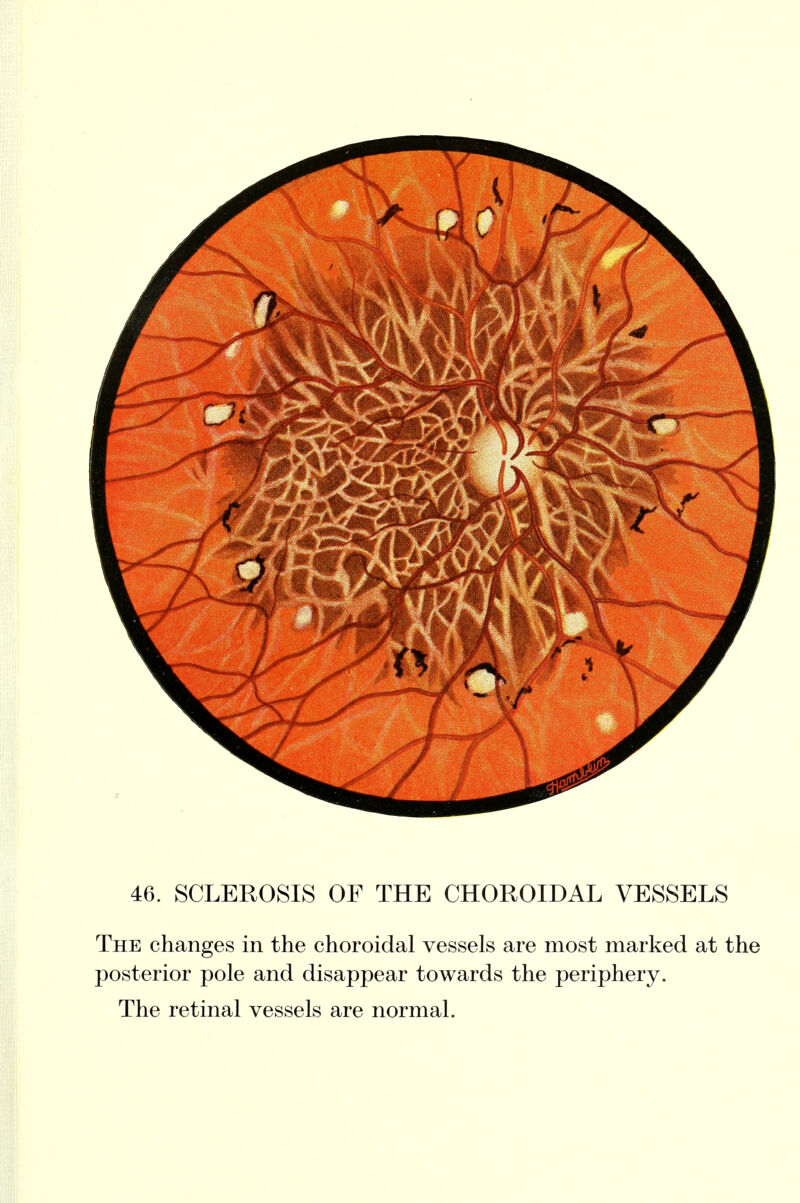 46. SCLEROSIS OF THE CHOROIDAL VESSELS The changes in the choroidal vessels are most marked at the posterior pole and disappear towards the periphery. The retinal vessels are normal.