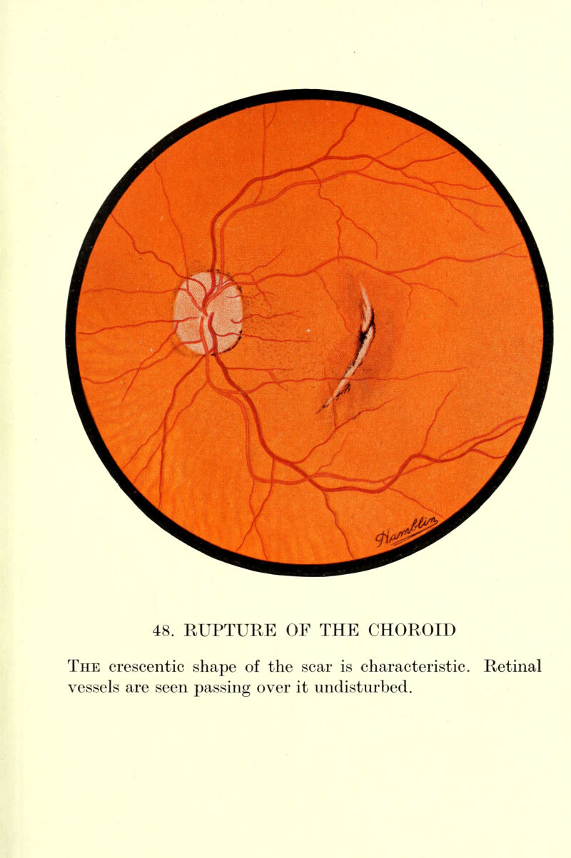 The crescentic shape of the scar is characteristic. Retinal vessels are seen passing over it undisturbed.