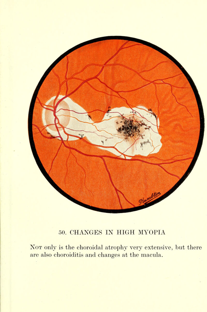 50. CHANGES IN HIGH MYOPIA Not only is the choroidal atrophy very extensive, but there are also choroiditis and changes at the macula.